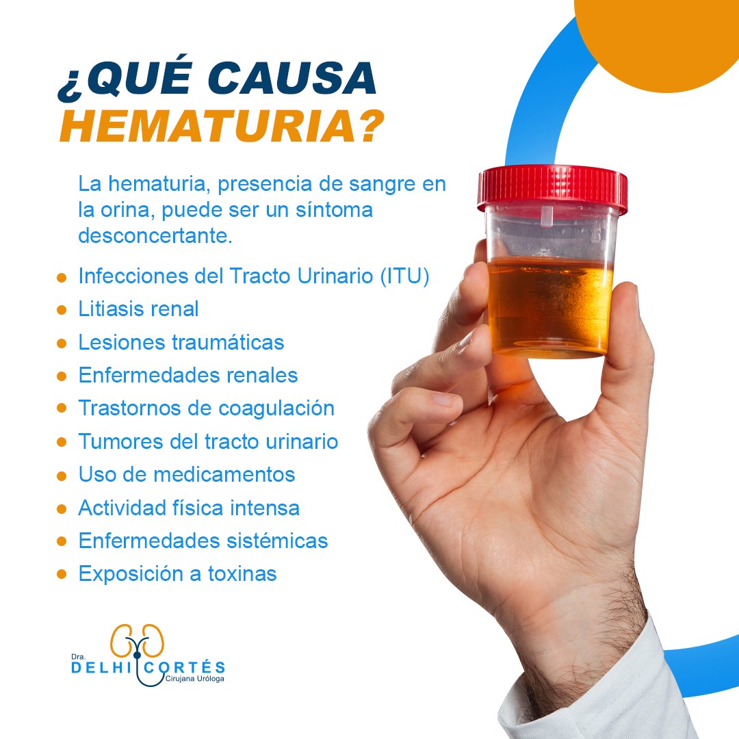 Ante la presencia de hematuria, es fundamental consultar a un profesional de la salud para identificar la causa subyacente y recibir el tratamiento adecuado. 🩺🩹
Agenda tu cita 👇
⚕️Doctoralia: https://www.doctoralia.com.mx/yeniseik-delhi-cortes-vazquez/urologo/san-andres-cholula
📞 Teléfono: 222 227 2713
✅ WhatsApp: 561 213 3757
Dirección:
📍 Periférico Ecológico 3507, int. 1229, Col. Emiliano Zapata, San Andrés Cholula
Horarios:
🕗Martes y jueves de 16:00 a 20:00 hrs
🕗Sábados de 10:00 a 14:00 hrs
👩⚕️ Dra. Delhi Cortés
Médico general, C.P. 09137489
Especialidad en urología, C.P. 12342044
Certificación del consejo Mexicano de Urología, 1787
#urología #urologo #médicourologo #urologa #urologocholula #urologacholula #médicocholula #urologoTlaxcala #Puebla #Tlaxcala #Cholula