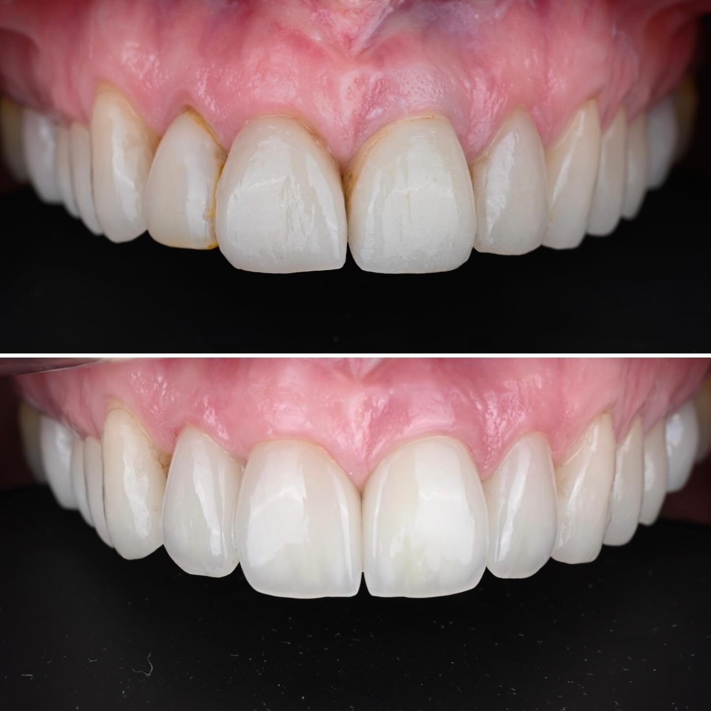 4 new front teeth (1 implant crown, 1 crown, 2 veneers) to make these teeth look better 😍 #estheticdentistry #highenddentistry #functionandesthethics #nophotoshop