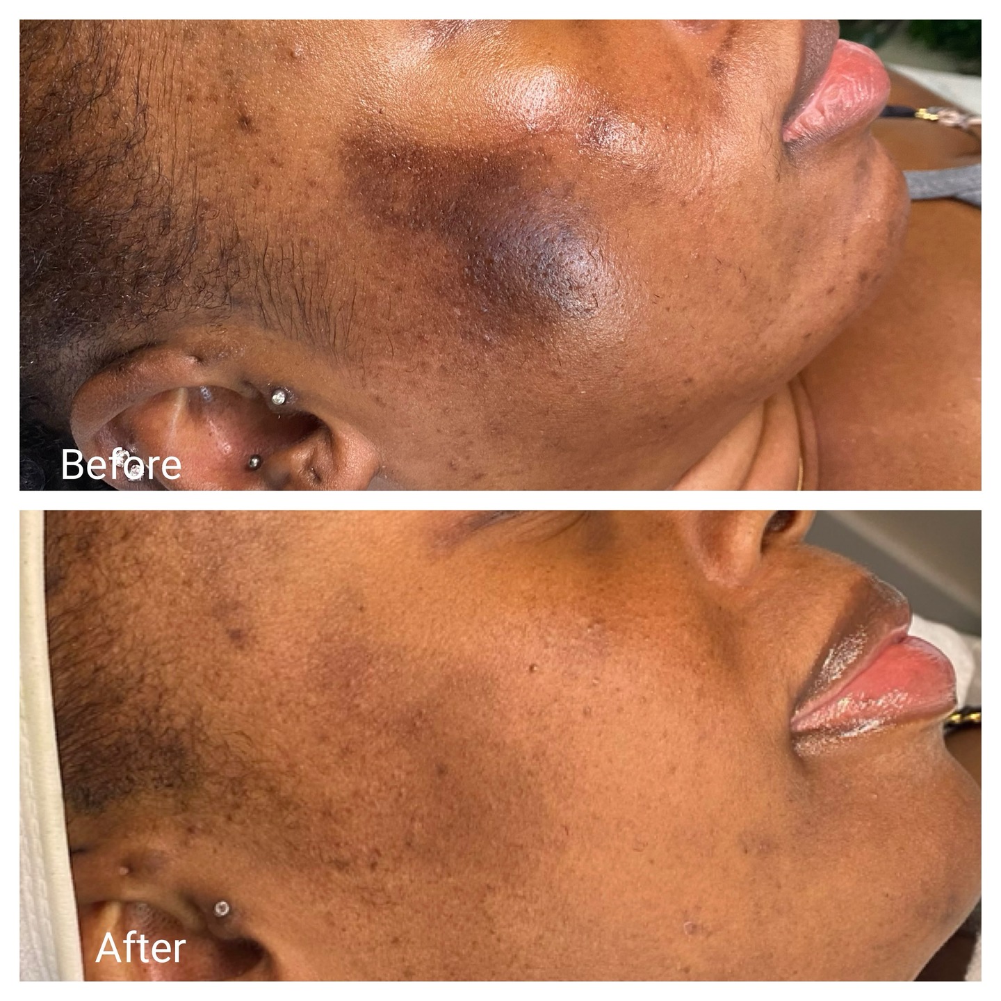 Another awesome result from using our AâUnique Skin Resurfacing Night Treatment Serum. đđ˝đđ˝
Using it is just as effective as getting a chemical peel. Say farewell to dullness as lactic and glycolic acids resurface your skin, leaving it noticeably brighter and more even-toned. This beauty used it as a spot treatment to reverse the large patch of hyperpigmentation from her skin.
#aestheticallyunique  #aestheticallyuniqueđ #facials #oilyskin #deepporecleansing #hyperpigmentation #browardesthetician #ftlauderdaleesthetician #coralspringsesthetician #broward #coralsprings #ftlauderdale #tamarac #esthetician #parkland #miami  #northlauderdale #boca   #women #men #microneedling #love #instapic #skincare #skincareroutine #skincareproducts #skincaretips #selfcare #glowingskin #antiaging