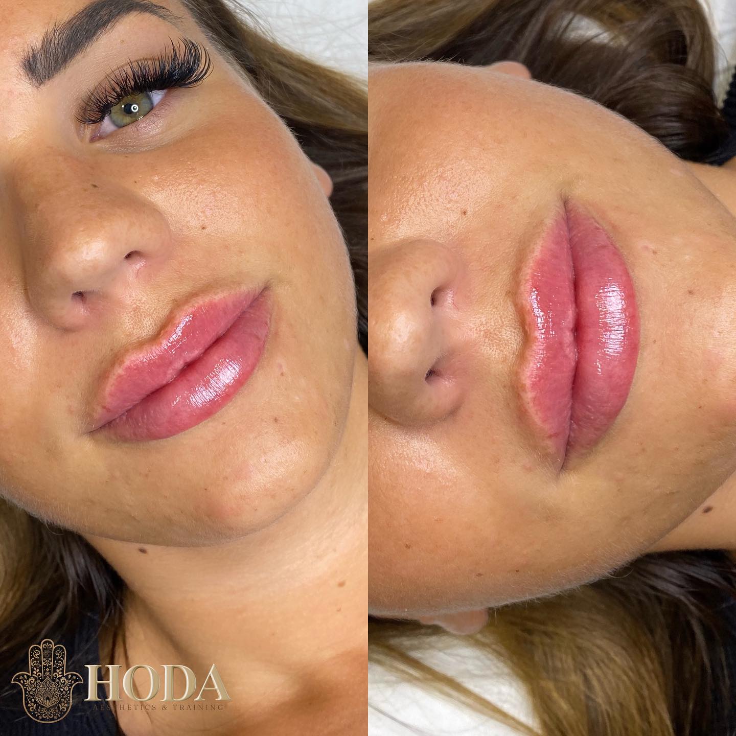 ๐๐ฎ๐๐ข๐จ๐ฎ๐ฌ ๐๐ข๐ฉ-๐
๐ข๐ฅ๐ฅ๐๐ซ
Just look at the perfect pout๐
We tailor the amount of ML needed for all of our clients as we know all our clients have different facial structures.
Whether you want a natural look or a more bold look, we offer it all!
When we inject our premium quality filler into all the right places you will be left with some of the most gorgeous lips in bournemouth.
๐๐๐๐ ๐๐๐๐๐๐
Advanced Aesthetic Practitioner | Fonder & Director
โซ๏ธAdvanced Aesthetics Clinic & Training Academy
โซ๏ธFoundation | Advanced | Masterclass I Mentoring | Shadow Days
๐Bournemouth, UK
โซ๏ธFor payments I accept PayPal/ bank transfer/card machine/cash ๐ณ
DM any questions
Website & booking link in bio
#bournemouthbeach #skinclinicbournemouth #bournemouthmums #bournemouthyoga #bournemouthrestaurant #bournemouthlips #bournemouthaesthetics #bournemouthdermalfiller #russianlipsbournemouth #dermalfillerbournemouth #dermalfillersouthampton #russianlipssouthampton #bournemouthtraining
#skinboostertraining #lipsbournemouth #lipfillerbournemouth