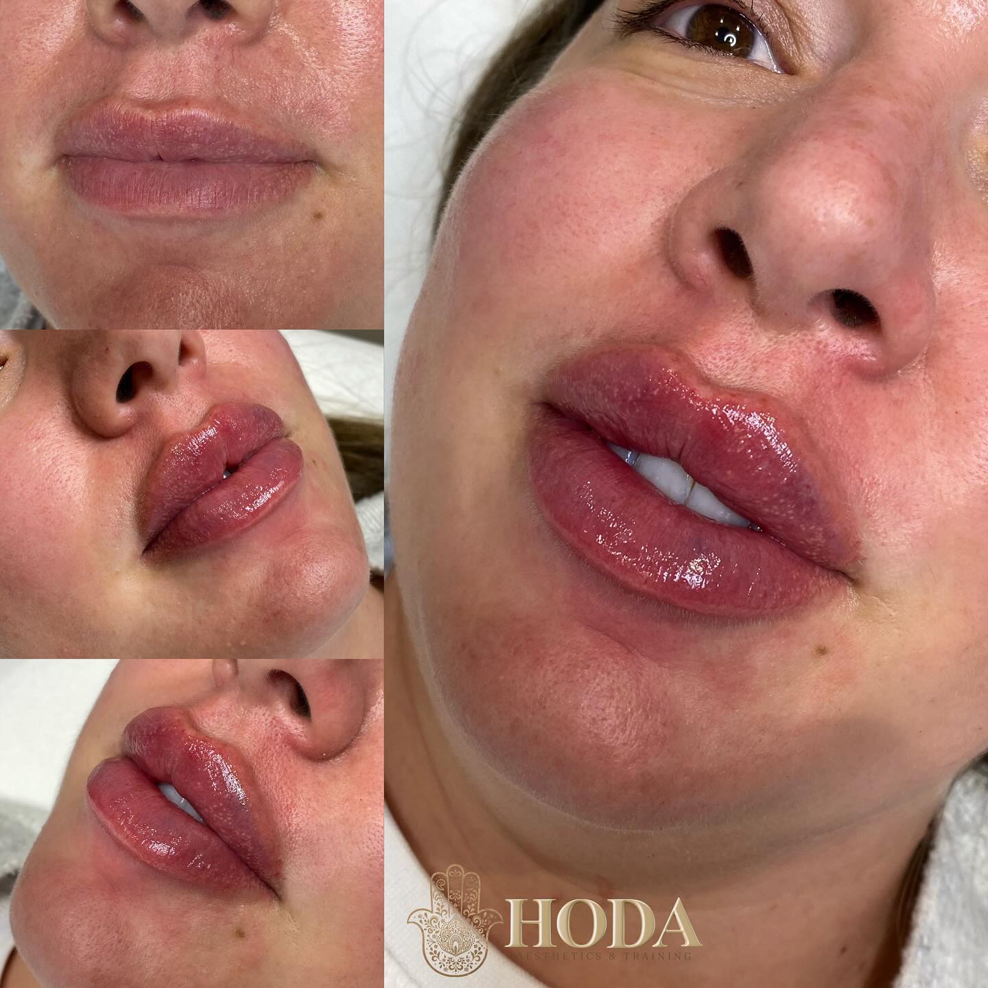๐๐๐๐จ๐ซ๐ ๐๐ง๐ ๐๐๐ญ๐๐ซ ๐๐ข๐ฉ ๐
๐ข๐ฅ๐ฅ๐๐ซ ๐
Lip Goals, Achieved! โจ
Stunning transformation from natural to luscious, fuller lips! ๐ Whether youโre looking for a subtle enhancement or a bolder pout, weโve got you covered with our expert lip filler techniques.
๐ Safe & professional
๐
Quick recovery
๐ Customized just for you
Get ready to love your new look! DM us for more info or to book your consultation today! ๐
Click on my website below to Book ๐๐ฝ
https://www.hoda-aesthetics.co.uk
๐๐๐๐ ๐๐๐๐๐๐
Advanced Aesthetic Practitioner | Fonder & Director
โซ๏ธAdvanced Aesthetics, Permanent Makeup Technician and Training Clinic
๐Bournemouth, UK
โซ๏ธFor payments I accept bank transfer/card machine/cash ๐ณ
#LipGoals #LipFiller #BeforeAndAfter #BeautyEnhancement #LusciousLips #ConfidenceBoost #LipTransformation #lipfillerbournemouth #microbladingbournemouth #lipfillerpoole #beautybournemouth #BournemouthAesthetics #browsbournemouth
