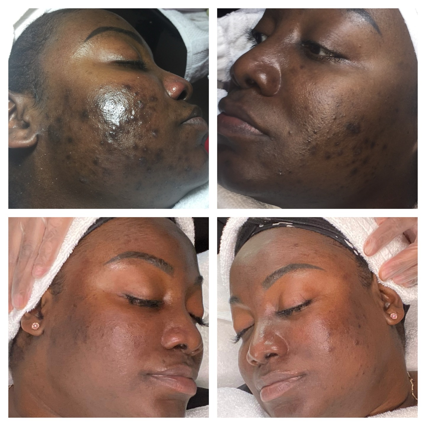 These amazing results were accomplished using our AâUnique Skin Resurfacing Night Treatment. This exquisite formula works tirelessly while you rest, encouraging cell turnover and unveiling a smoother, more luminous complexion with each awakening.
AâUnique Skin Resurfacing Night Treatment is designed by our licensed esthetician to elevate your nightly beauty ritual. This luxurious formula blends science and nature to transform your skin while you sleep.
Elevate your skincare routine with AâUnique Night Treatment. Where science meets indulgence. Treat yourself to timeless elegance and wake up to a renewed, radiant complexion. Available on Auniqueskinstore.com