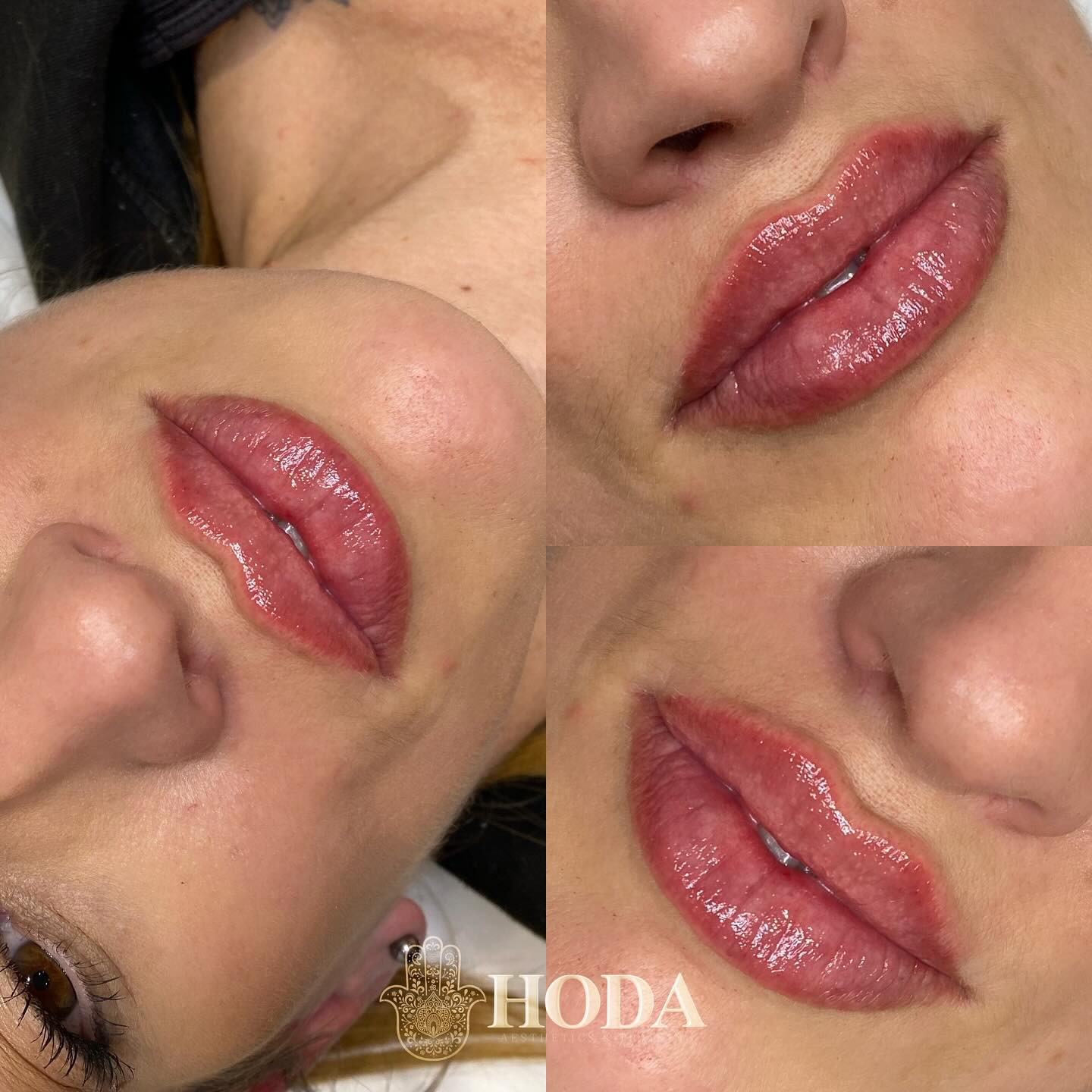 ๐๐๐ฉ๐ฉ๐ฒ ๐
๐ซ๐ข๐๐๐ฒ ๐ ๐ฎ๐ฒ๐ฌ ๐
Looking to add a little volume to your lips? ๐
Lip fillers offer a quick and customisable way to enhance your natural beauty! Whether youโre aiming for a subtle boost or a more defined pout, Iโm here to help you achieve the perfect look.
Treatment 1.1ml Russian Lips
๐๐๐๐ ๐๐๐๐๐๐
Advanced Aesthetic Practitioner | Fonder & Director
โซ๏ธAdvanced Aesthetics Clinic
๐Bournemouth, UK
โซ๏ธFor payments I accept bank transfer/card machine/cash ๐ณ
DM any questions
Website & booking link in bio
#LipFillers #BeautyEnhancement #PoutPerfection #LipGoals #BournemouthLipFillers #lipfillerbournemouth #LipEnhancementBournemouth #PoutGoalsBournemouth #LipFillerExperts #BournemouthBeauty #BournemouthAesthetics