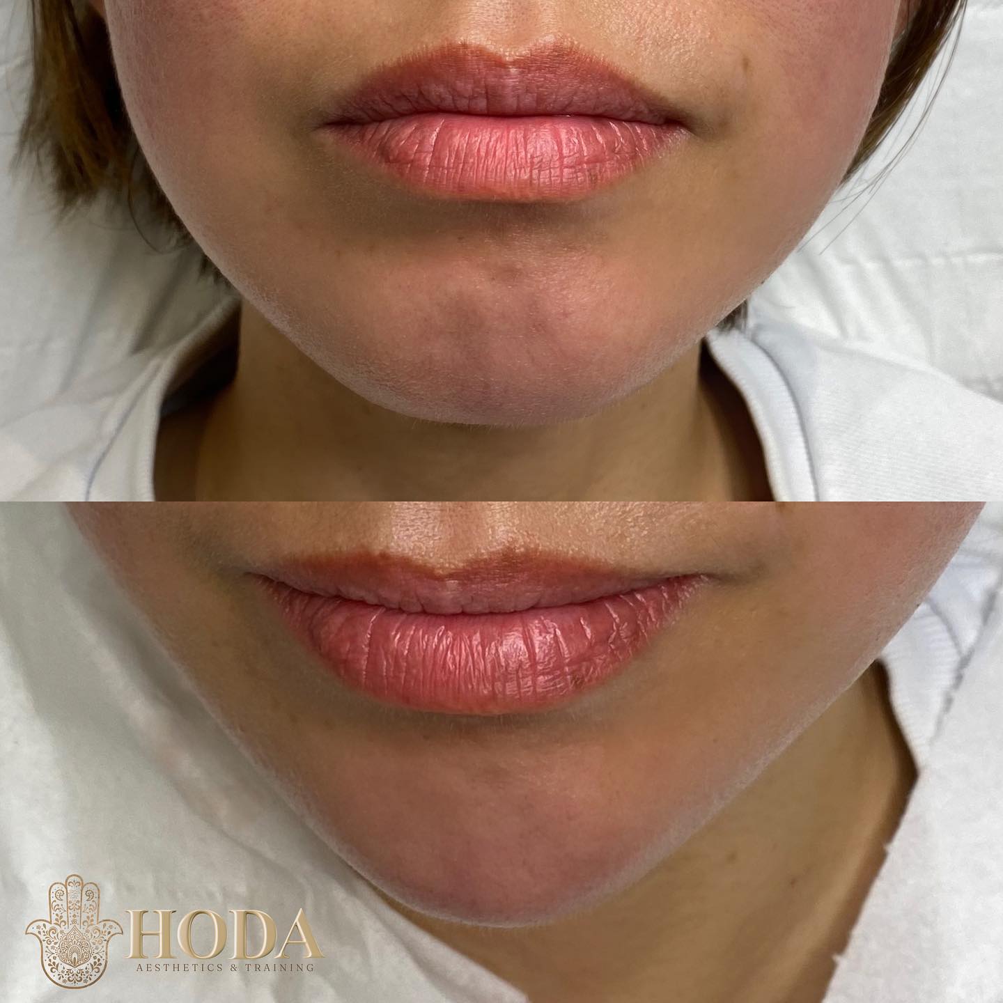 ๐๐ก๐ข๐ง ๐
๐ข๐ฅ๐ฅ๐๐ซ ๐
Chin fillers are dermal fillers injected into the chin with the goal of enhancing the shape, size, or proportion of the chin. It can be done as a single treatment or as a series of injections spaced 4-6 weeks apart, depending how much the chin needs to be built up.
It is a nonsurgical procedure that is not permanent but can last several years. Many clients getting chin fillers hope that the procedure will give them a stronger, more balanced chin. Chin filler can last quite a long time, between 10-24 months.
You can also learn this on our foundation to dermal filler course!
๐๐๐๐ ๐๐๐๐๐๐
Advanced Aesthetic Practitioner | Founder & Director
โซ๏ธAdvanced Aesthetics Clinic & Training Academy
โซ๏ธFoundation | Advanced | Masterclass I Mentoring | Shadow Days
๐Bournemouth, UK
โซ๏ธFor payments I accept Klarna/PayPal/ bank transfer/card machine/cash ๐ณ
DM any questions
Website & booking link in bio
#bournemouthbeach #skinclinicbournemouth #bournemouthmums #bournemouthyoga #lipsbournemouth #bournemouthrestaurant #bournemouthlips #bournemouthaesthetics #bournemouthdermalfiller #russianlipsbournemouth #dermalfillerbournemouth #dermalfillersouthampton #russianlipssouthampton #bournemouthtraining
#lipspoole #poolelips