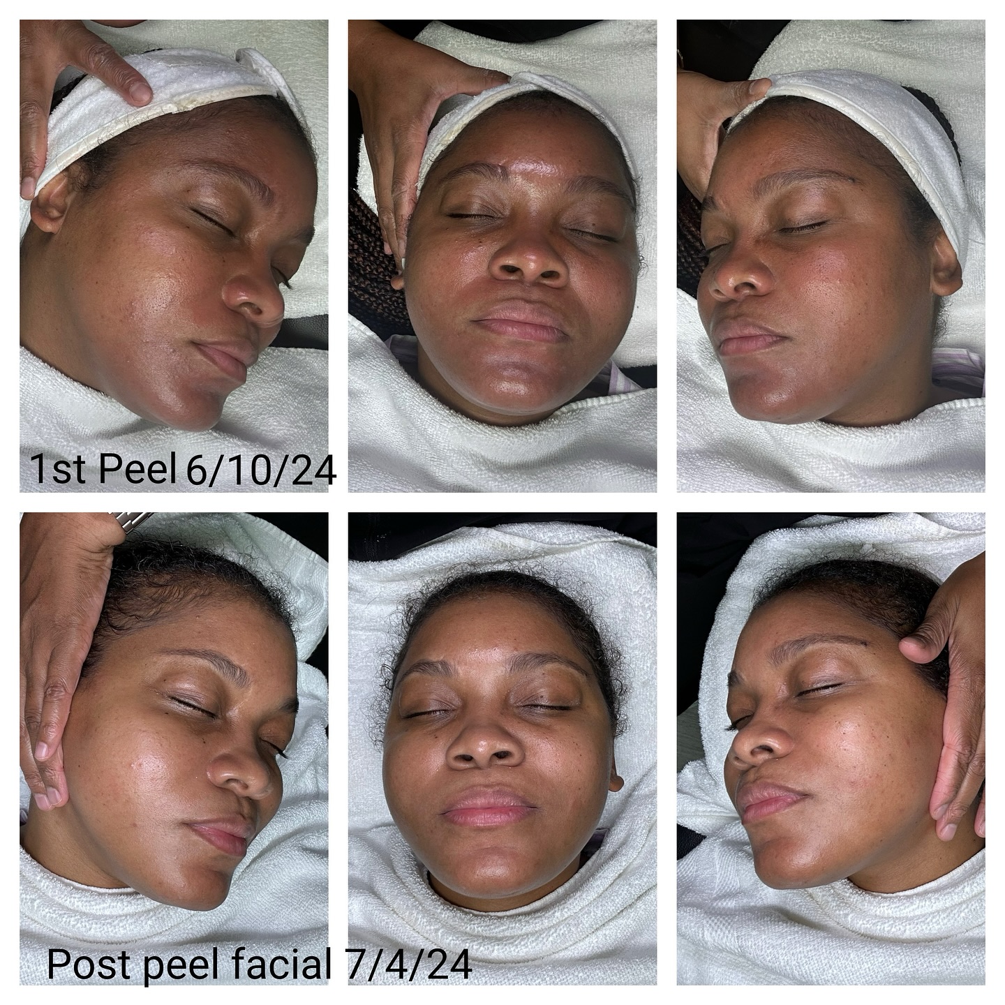 This beauty has officially begun her transformation back to healthy vibrant skin. In just one month we achieved amazing results. We did her first AâUnique peel treatment and sent her home with our AâUnique Detoxifying Cleanser, Pigment balancing bar, and Intense illuminating moisturizer. Look at the difference in her skin!!! đđ˝ Our AâUnique products are highly effective in reversing and revitalizing skin from problematic issues. Available on our website at Auniqueskinstore.com
#skincare #skincareroutine #skincareproducts #skincaretips #selfcare #glowingskin #antiaging #cosmetics #healthyskin #blackgirlskincare #blackskincare #naturalskincare  #ftlauderdaleesthetician #coralspringsesthetician #broward #coralsprings #ftlauderdale #tamarac #esthetician #parkland #miami