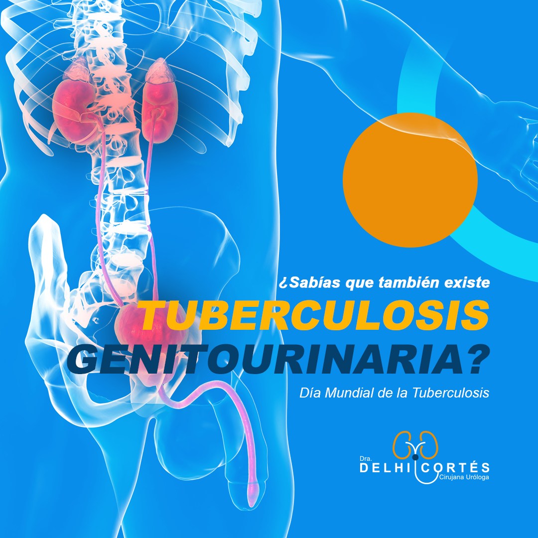 👉La tuberculosis genitourinaria afecta los órganos genitales y el tracto urinario. Es causada por la bacteria Mycobacterium tuberculosis, que también es responsable de la tuberculosis pulmonar, pero en este caso afecta los riñones, la vejiga, los genitales y los conductos urinarios.
👉Síntomas:
🔸Dolor abdominal
🔸Dificultad para orinar
🔸Secreciones genitales
🔸Fiebre y pérdida de peso
❗Es importante señalar que la tuberculosis genitourinaria es relativamente rara, pero si se sospecha, es esencial buscar atención médica para un diagnóstico y tratamiento adecuados.
Agenda tu cita 👇
⚕️Doctoralia: https://www.doctoralia.com.mx/yeniseik-delhi-cortes-vazquez/urologo/san-andres-cholula
📞 Teléfono: 222 227 2713
✅ WhatsApp: 561 213 3757
Dirección:
📍 Periférico Ecológico 3507, int. 1229, Col. Emiliano Zapata, San Andrés Cholula
Horarios:
🕗Martes y jueves de 16:00 a 20:00 hrs
🕗Sábados de 10:00 a 14:00 hrs
👩⚕️ Dra. Delhi Cortés
Médico general, C.P. 09137489
Especialidad en urología, C.P. 12342044
Certificación del consejo Mexicano de Urología, 1787
#urología #urologo #médicourologo #urologa #urologocholula #urologacholula #médicocholula #urologoTlaxcala #Puebla #Tlaxcala #Cholula