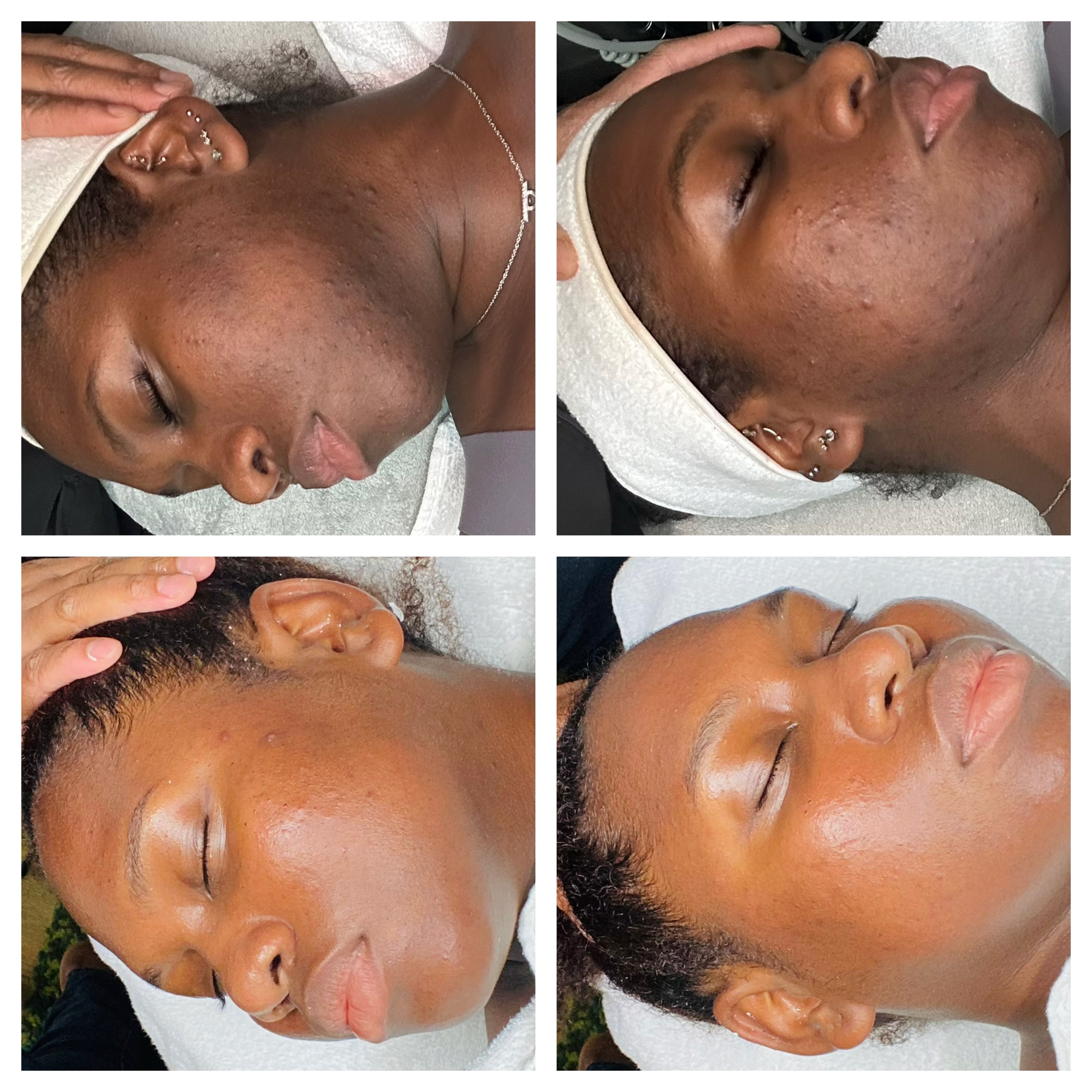Letâs get into these RESULTS!!! After years of suffering from dull acne prone skin. This beauty was able to transform her skin using our AâUnique Detoxifying Dermal Cleanser, Fortifying Skin Balancer, and Acne Eliminating Serum. Look at how beautifully it resolved her acne, balanced and evened out her skin tone. đđ˝đđ˝â¨
 #auniqueskin #correctiveskincareproducts #correctiveskincare #esthetician #facials #oilyskin #deepporecleansing #hyperpigmentation #browardesthetician #ftlauderdaleesthetician #coralspringsesthetician #broward #coralsprings #ftlauderdale #tamarac  #parkland #miami #broward #northlauderdale #boca #womeninbusiness #womenempowerment #women #men #instagood #florida #beauty #trending #trendingreels #trend #aestheticallyunique