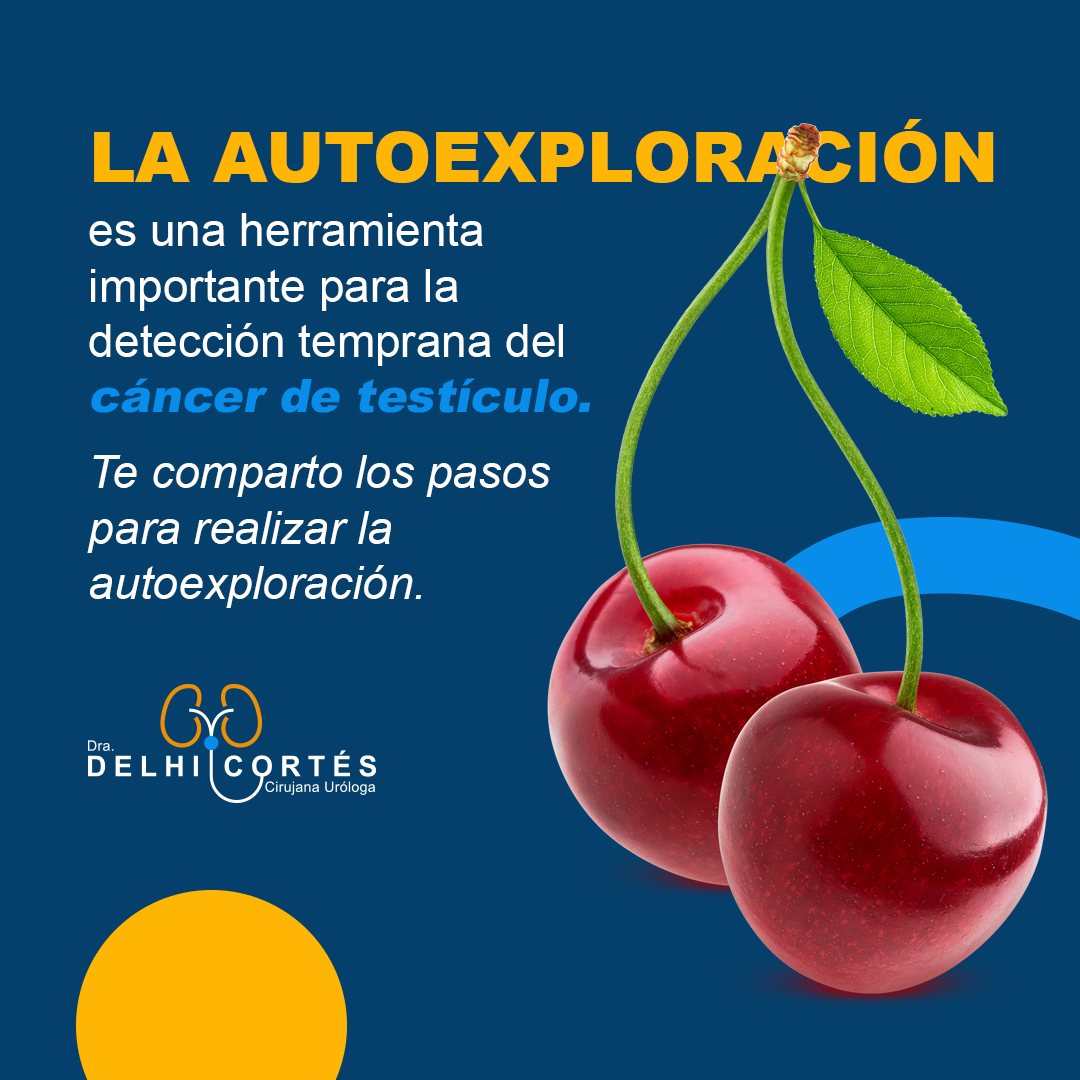 ❗La autoexploración testicular implica examinar regularmente los testículos para identificar posibles cambios en su forma, tamaño, textura o la presencia de bultos.
👉Pasos que puedes seguir para realizar la autoexploración testicular:
✅La mejor hora para realizar la autoexploración es después de un baño o ducha, ya que el calor del agua relaja el escroto y facilita la detección de cualquier anormalidad.
✅Observa tus testículos en un espejo para identificar cualquier hinchazón, enrojecimiento o cambios en la piel del escroto.
✅Sostén cada testículo entre los dedos pulgar e índice y rueda suavemente entre los dedos. Deberías sentir una textura firme pero suave. Presta atención a cualquier bulto, hinchazón, o cambio en la forma o tamaño del testículo.
✅Asegúrate de comparar ambos testículos para identificar cualquier asimetría. Es normal que un testículo sea ligeramente más grande o bajo que el otro.
✅La autoexploración testicular se puede realizar mensualmente para detectar cualquier cambio temprano. Si encuentras alguna anormalidad, no dudes en consultar a un profesional de la salud.
🙌La autoexploración testicular es una práctica importante para la detección temprana del cáncer de testículo, pero no debe sustituir las visitas regulares al médico para chequeos completos.
Agenda tu cita 👇
⚕️Doctoralia: https://www.doctoralia.com.mx/yeniseik-delhi-cortes-vazquez/urologo/san-andres-cholula
📞 Teléfono: 222 227 2713
✅ WhatsApp: 561 213 3757
Dirección:
📍 Periférico Ecológico 3507, int. 1229, Col. Emiliano Zapata, San Andrés Cholula
Horarios:
🕗Martes y jueves de 16:00 a 20:00 hrs
🕗Sábados de 10:00 a 14:00 hrs
👩⚕️ Dra. Delhi Cortés
Médico general, C.P. 09137489
Especialidad en urología, C.P. 12342044
Certificación del consejo Mexicano de Urología, 1787
#urología #urologo #médicourologo #urologa #urologocholula #urologacholula #médicocholula #urologoTlaxcala #Puebla #Tlaxcala #Cholula