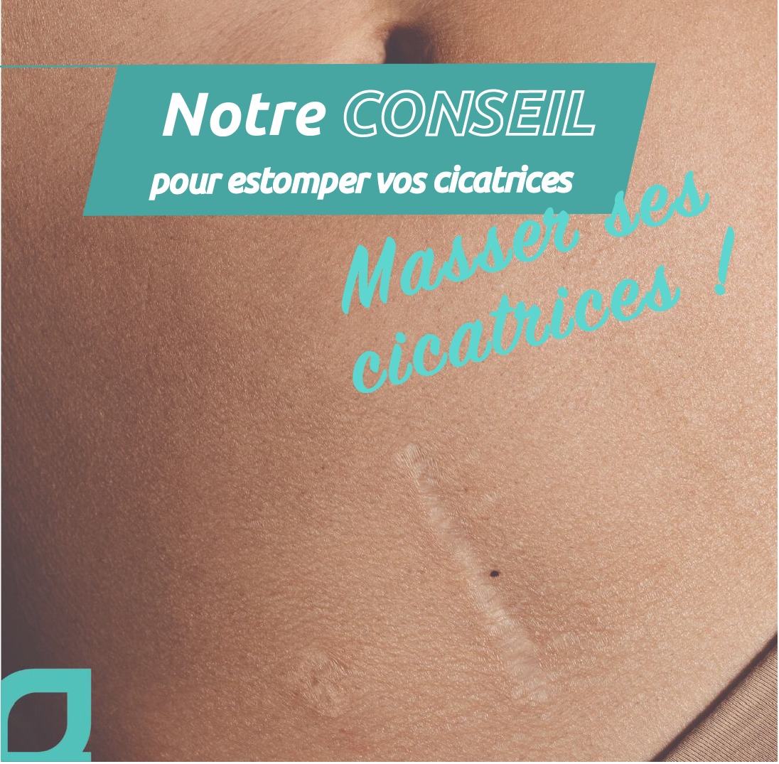 Pour améliorer l’aspect de votre cicatrice, il est très important de la masser. Et pour une action en profondeur, l'utilisation des huiles essentielles et végétale comme celle présentes dans cica-concentré est recommandé.
Le plus de masser votre cicatrice avec cica ? C’est une huile végétale.
Le plus des huiles végétales ? Elles facilitent le massage, apporte de la souplesse au tissus cicatriciel et une meilleurs absorption des huiles essentielles qui vont agir en profondeur pour améliorer la réparation.
Et comment masser votre cicatrice ? Nous vous donnons une technique de massage douce qui peut s'adapter à tous.
Avec le plat de la main, ou avec la pulpe du doigt, imprimez un mouvement horizontal vers la gauche, la droite, le haut, le bas, toujours très délicatement, en évitant toute sensation de douleur.
Si vous avez des appréhensions, cette mobilisation de la peau peut être faite dans un premier temps au travers des vêtements (en coton) à distance. L’important c’est de mobiliser et de prendre confiance.
Sur quelles cicatrices ? Toutes les cicatrices sèches, bien refermées : les anciennes bien sûr et pour les plus récentes, celles ayant au moins 15 jours ou 1 mois. Et si vous avez le moindre doute, vérifiez avec votre médecin.
À quelle fréquence ? 2 ou 3 fois par semaine. Très délicatement.
Pour en savoir plus, n'hésitez pas à aller voir sur notre site : www.ianthis.com.
#naturel #santédelapeau #ianthislab #skintips #huilesessentielles #skincaretips #peauxsensibes