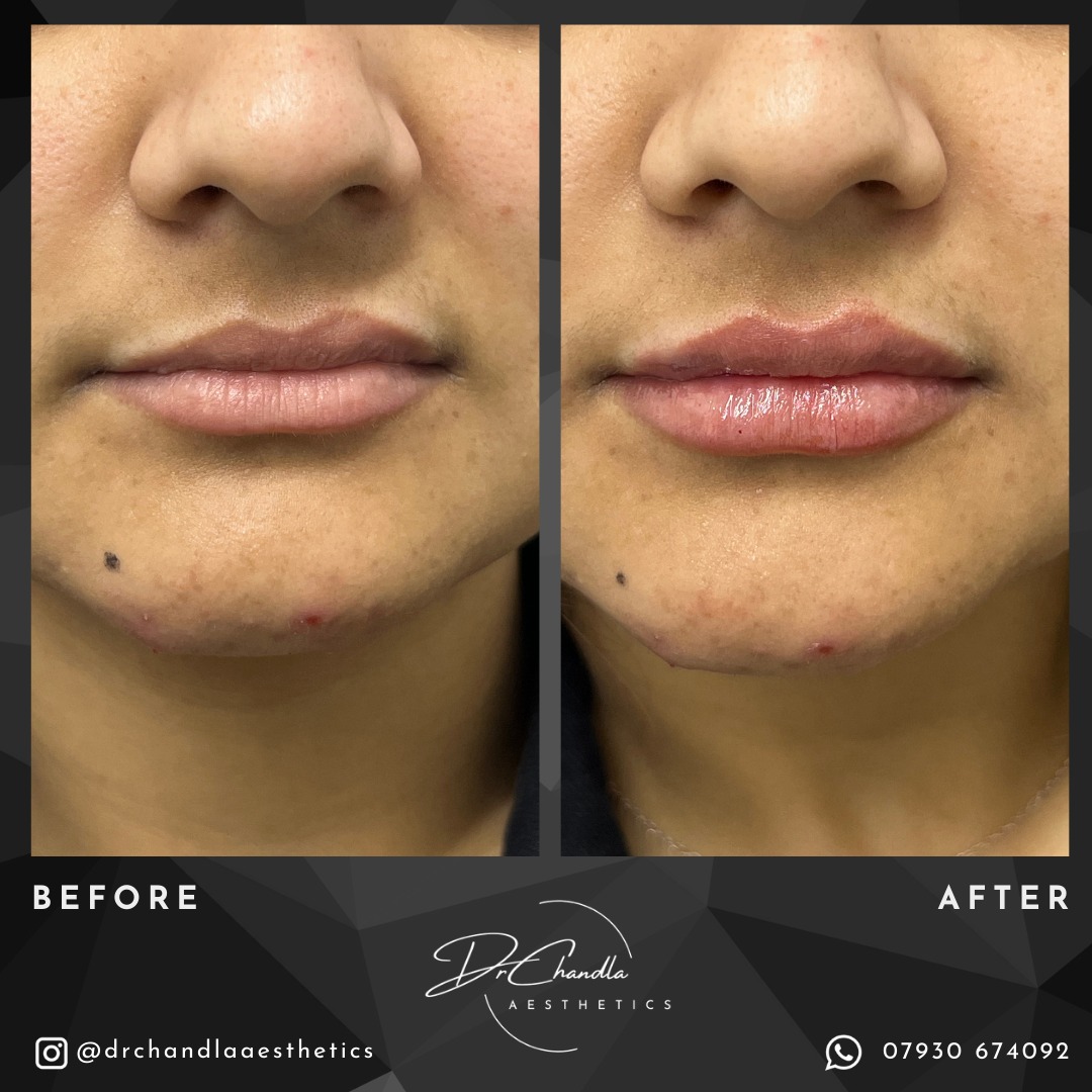 Happy client, happy injector!
This client underwent Lip Augmentation treatment and wanted a natural looking enhancement to the shape and volume of her lips. She was treated using a small volume of Relife Definisse Touch with the lollipop technique 🍭.
This was her first aesthetic procedure and she is very pleased with the results!
At Dr Chandla Aesthetics, every client receives a bespoke treatment plan to ensure they get the best, tailored results.
To find out more or book your own Lip Augmentation treatment with Dr Chandla, please get in contact via DM or WhatsApp.
Dr Chandla Aesthetics is a Doctor Led Medical Aesthetics Clinic.
WhatsApp: 07930674092
Email: info@drchandlaaesthetics.co.uk
www.drchandlaaesthetics.co.uk