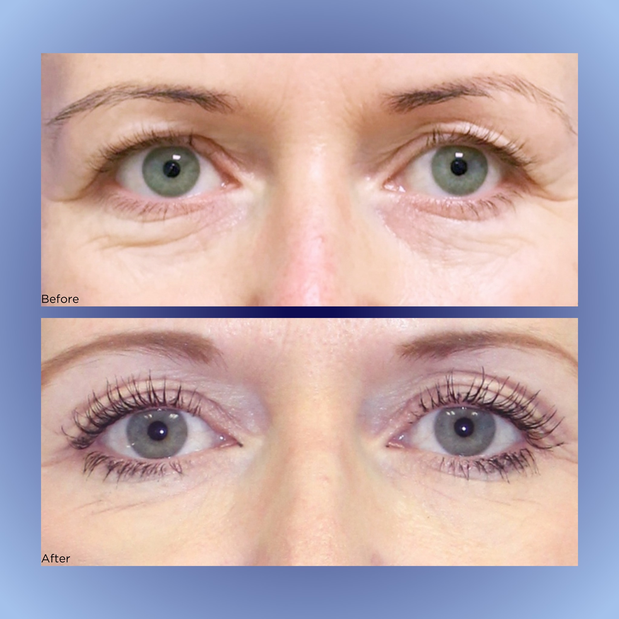Results are after 3 PRP treatments πβ¨π§¬ Book your under-eye treatment today and start seeing results!
Results achieved by Dr Aust and colleaguesβ (2018)