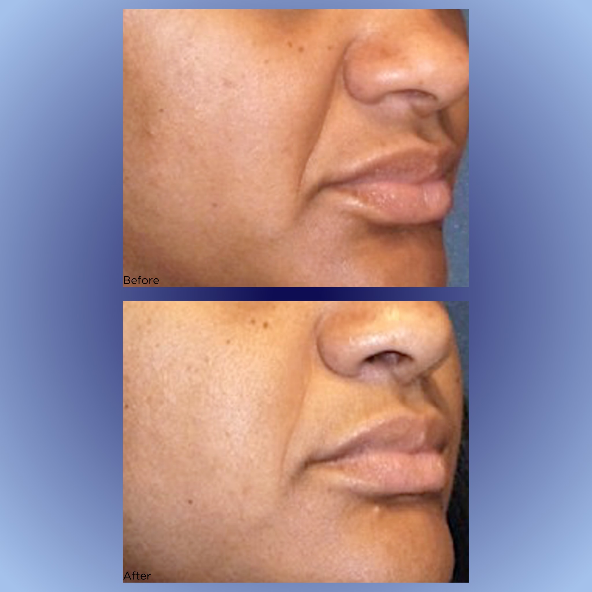 PRP FACIALS π Turn back time with PRP facials, for tighter, younger-looking skin! β¨πββοΈ
#PlateletRichPlasma #prp #PRPtherapy #plateletrichplasma #plateletrichplasmatherapy #plateletrichplasmainjection
Reference: Sevilla, G. P., Dhurat, R. S., Shetty, G., Kadam, P. P., & Totey, S. M. (2015). Safety and efficacy of growth factor concentrate in the treatment of nasolabial fold correction: Split face pilot study.Β Indian journal of dermatology.