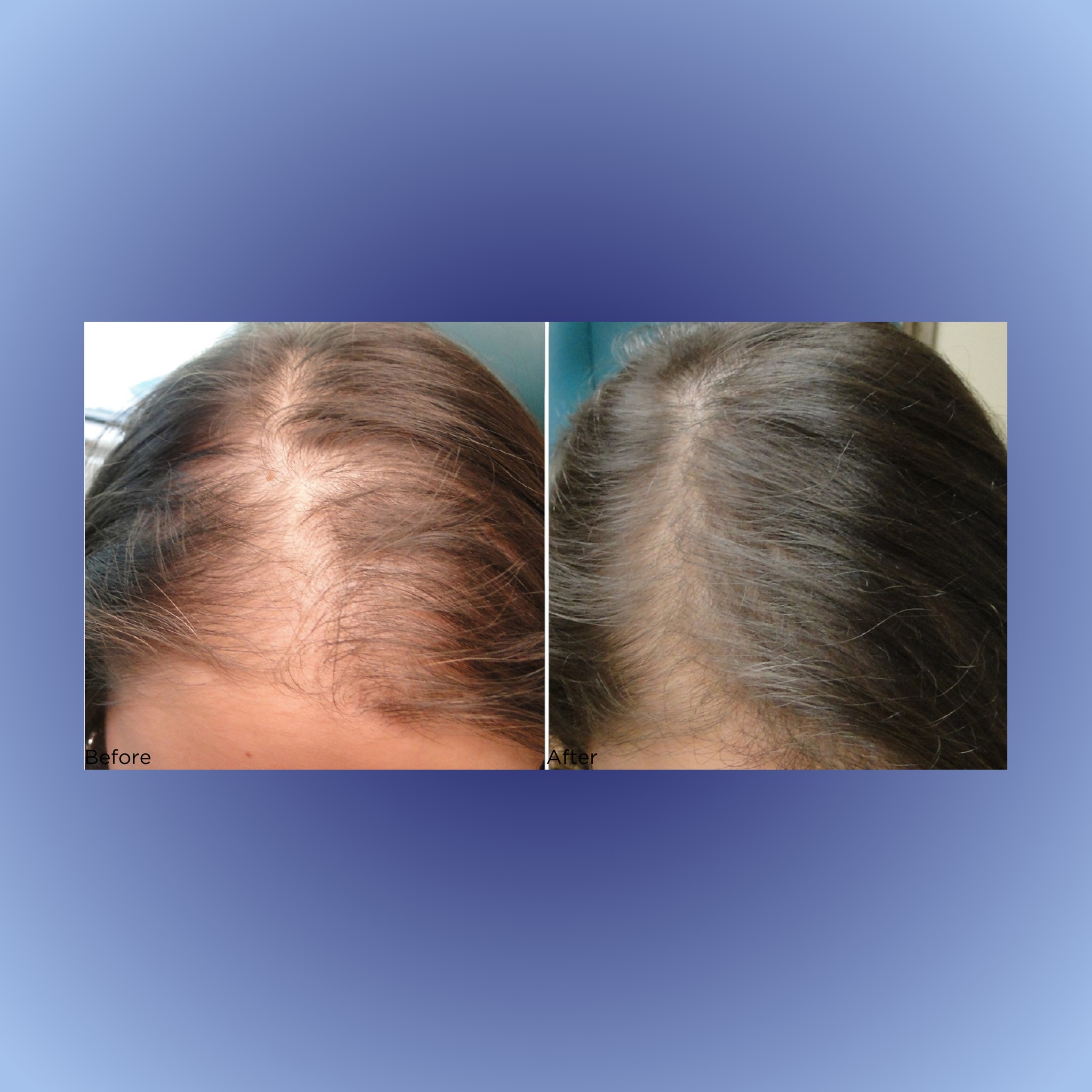 Say goodbye to hair loss with PRP - the natural solution to regaining thicker, fuller looking hair! ππΌ Results after 3 PRP treatments! #PRP #hairlosssolution #hairrestoration #prpsunshinecoast