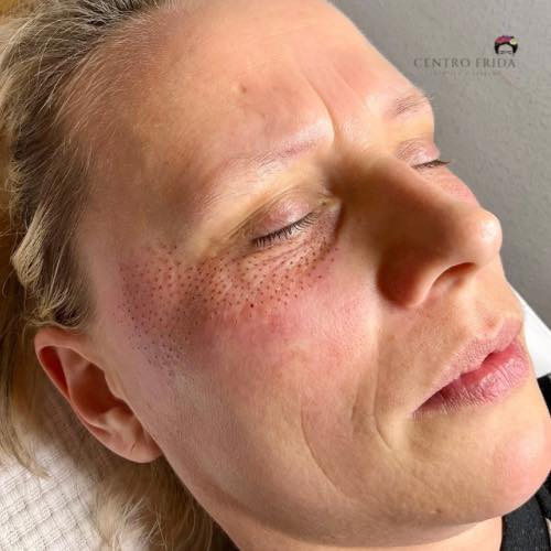 ¡Es hora de darle a tus ojos el cuidado que se merecen! 😉
En Centro Frida, estamos emocionados de anunciar que ya hemos abierto nuestra agenda para citas en septiembre para el rejuvenecimiento de mirada con Plasampen.
Plasampen es una técnica innovadora y efectiva para revitalizar y rejuvenecer la zona de los ojos. Con resultados notables y duraderos, es la opción perfecta para aquellos que desean lucir frescos y rejuvenecidos.
No esperes más, ¡agenda tu cita ahora mismo para septiembre en Centro Frida y descubre los beneficios del rejuvenecimiento de mirada con Plasampen!
Centro Frida
Estética & Belleza 🌸
📲 624252194
••••••••••••••••••••••••
#plasmapenmadrid #dermapenmadrid #esteticamadrid #microblading #microbladingmadri #plasmapencuello #dermapenmadrid #presoterapiacorporal #maderoterapiamadrid