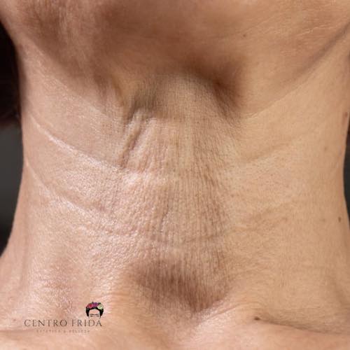 ✨Revoluciona tu piel con Plasmapen: Cuello y Papada Sin Cirugía ✨
¿Te preocupa la flacidez en el cuello o la papada? ¡El Plasmapen es la solución no invasiva que estabas esperando!
¿Cómo funciona? 👀👉🏻El Plasmapen utiliza energía de plasma, un tipo de gas ionizado, para estimular la regeneración de la piel. A través de pequeñas descargas controladas, se crea un efecto térmico que tensa y reafirma la piel sin necesidad de bisturí.
💥 Beneficios:
✨Mejora la elasticidad de la piel en zonas difíciles como el cuello y la papada.
✨Reduce la flacidez y las líneas de expresión.
✨Resultados visibles en pocas sesiones, con una recuperación mínima.
✨Sesiones rápidas y efectivas: ¡En tan solo unos minutos, notarás cómo tu piel se ve más firme y rejuvenecida! 👏
📅 Reserva tu consulta hoy y olvídate de la flacidez en la papada y cuello. ¡Tu mejor versión está a un paso!
Centro Frida
Estética & Belleza 🌸
📲 624252194
••••••••••••••••••••••••
#CentroFrida #Plasmapen #DescuentoEspecial #BellezaPostVerano #CuidadoDeLaPiel #estética