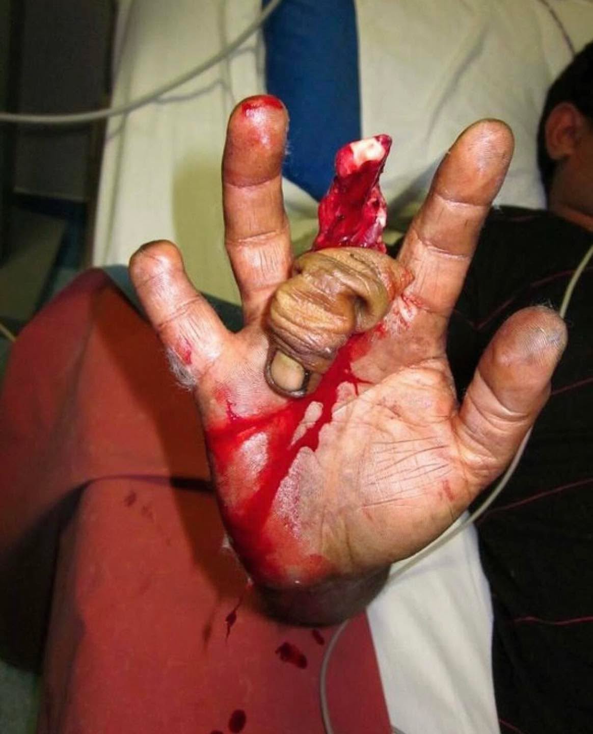 Patient sustained a ring avulsion injury to his middle finger!!
Avulsion is an injury in which a body structure is forcibly detached from its normal point of insertion by
either trauma or surgery. The term most commonly refers to a surface trauma where all layers of the skin have been torn away, exposing the underlying structures. Damage from the abrupt and often harsh tug of the caught ring can range from a simple bruise to "degloving" of soft tissue - pulling the skin off and stripping away the nerves, tendons and bone.
Severe accidents may result in traumatic amputation of the finger. Ring avulsion can be among one of the most devastating traumatic finger injuries, as often replantation following severe soft tissue damage is not possible.
Fortunately, advances in microsurgery have improved results with ring avulsion replantation.
Credit:@medicaltalks
#tactical #save #human #trauma #training #teaching #learning #community #medical #bethechange #life #vaemstg #emt #firefighter #fire #paramedic #ems #reels #school #education #virginia #group #youtube #knowledge #instagram #trending #facebook