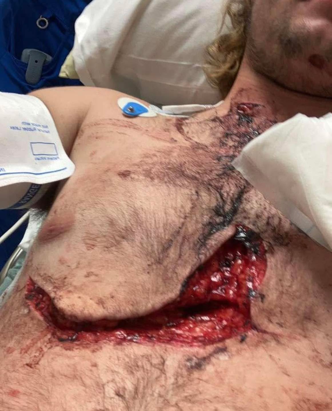 A house party fight leads to this guy being stabbed in the neck and chest, with the chest wound also being sliced open. You're first on scene. Knowing average dispatch->arrival time could be as high as 8 min in urban areas for paramedics to arrive, what are some immediate interventions you can perform as a bystander or arriving police officer with your medical kit?
Credit:specialforcesmedics
#tactical #save #human #trauma #training #teaching #learning #community #medical #bethechange #life #vaemstg #emt #firefighter #fire #paramedic #ems #reels #school #education #virginia #group #youtube #knowledge #instagram #trending #facebook