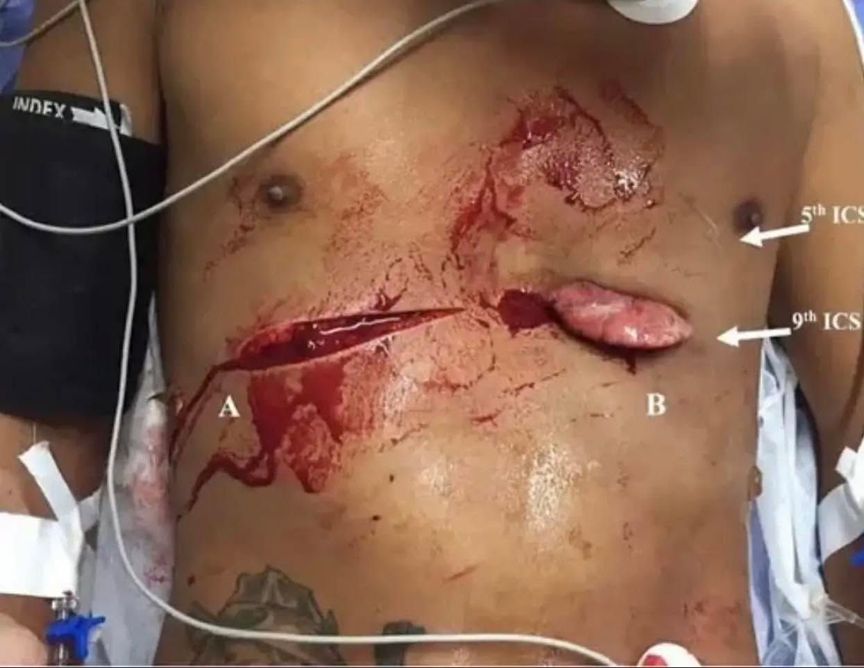 ⚠️Training Graphic ⚠️
Fire/EMS, how would you stabilize in the field?
Lung Protrusion: Tragic Consequence Of A Knife Assault
Lung Protrusion refers to the exposure of lung parenchyma from a defect in the chest wall. This is a case of knife assault which caused lung evisceration.
A 20-year-old presented to the Emergency Department with bilateral stab wounds in the thorax, causing lung protrusion.
He also had exposed lung parenchyma on the left side. He was breathless at the time of presentation with unbearable pain on both sides of the chest wall.
The doctors administered 1L of normal saline to the boy.
Moreover, Ketoprofen and Tramadol were also given to relieve pain. To manage shortness of breath, he was provided oxygen at the rate of 6 Litres/min.
The trauma team had advised an emergency operation.
Fortunately, the eviscerated lung, the "lingula" was not necrosed. There were no other complications. Moreover, the left side showed hemothorax.
Restoration of normal anatomy
The operation was a success. Furthermore, the surgeons irrigated the thorax with normal saline. They intubated the boy after this. There was no air leakage. They suctioned the fluid out and sutured the thorax. A thoracostomy tube drained the excess secretions.
Post-operative
The doctors followed up with the young boy. Fortunately, the wound was healing normally and he was fully functional.
Credit @hidocdr
Follow us:
Facebook: Virginia EMS Training Group
Instagram: @va_ems_training_group
YouTube: @vaemstg
#tactical #save #human #trauma #training #teaching #learning #community #medical #bethechange #life #vaemstg #emt #firefighter #fire #paramedic #ems #reels #school #education #virginia #group #youtube #knowledge #instagram #trending #facebook