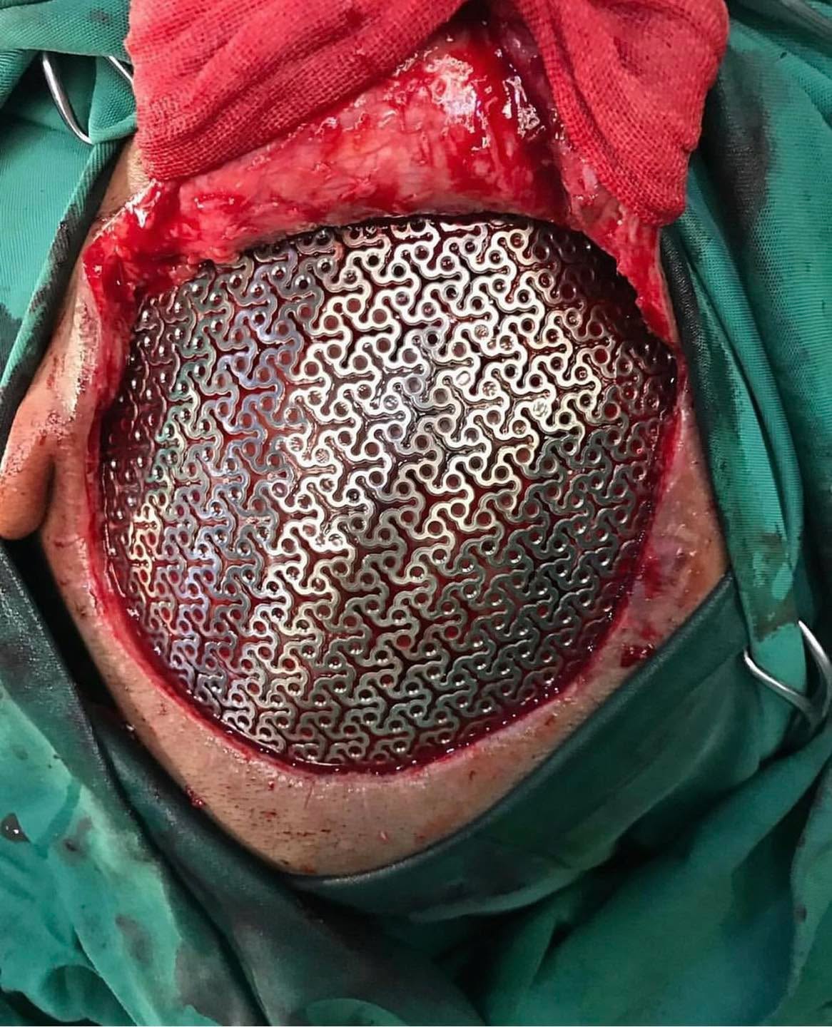 This patient has now a skull made of metal!!
Shown here is an implantable titanium mesh prosthesis used during cranioplasty.
Cranioplasty refers to surgical reconstruction of the skull. It is performed by filling the defective area with a range of materials, usually a bone piece from the patient or a synthetic material.
Titanium cranioplasty is the operative repair of a skull defect with an ergonomically manufactured plate to restore cosmesis, cranial function and reduce complications.
Titanium is a hardy material that can withstand heavy loading forces. Additionally titanium carries a lower risk of an immunological response than other metals, making it useful during surgeries involving bones.
Some patients present with skull traumatic defects (physical assault, motor vehicle accident, sporting injury) or with tumours or infections involving skull bones.
Such patients may need reconstruction of the skull by lifting the scalp and restoring the contour of the skull with the original skull piece or a custom contoured graft made from material that can be safely and effectively carried out with titanium (mesh or plate) or 3D printed implants, or a polymer
"bone cement" compound.
With children younger than 3 years old, growing skull fractures and congenital anomalies are common causes. The aim of cranioplasty is not only a cosmetic issue; also, the repair of cranial defects gives relief to psychological drawbacks and increases the social performances. On the other hand, contraindications for cranioplasty are the presence of hydrocephalus, infection, and brain swelling.
The plate has now been screwed into the surrounding skull bone of the patient, and the scalp is then closed over this new strong, cosmetically sound area.
The titanium and other modern bone substitutes used in today's cranioplasty operations are MRI-compatible and don't set off airport metal detectors.
Credit: @surgerycases
#tactical #save #human #trauma #training #teaching #learning #community #medical #bethechange #life #vaemstg #emt #firefighter #fire #paramedic #ems #reels #school #education #virginia #group #youtube #knowledge #instagram #trending #facebook