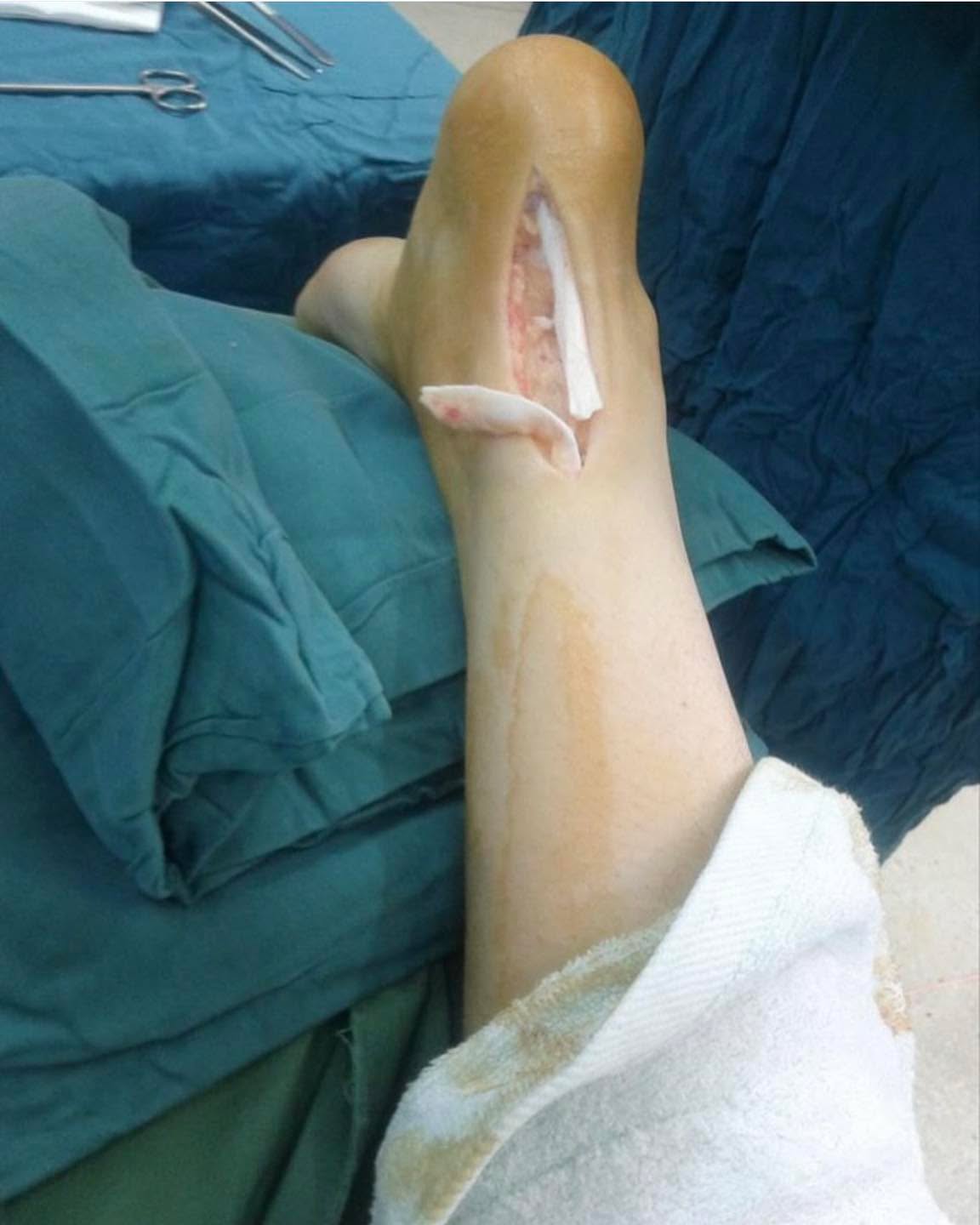 What's the name of this exposed piece?
Credit:Medicalzy
#tactical #save #human #trauma #training #teaching #learning #community #medical #bethechange #life #vaemstg #emt #firefighter #fire #paramedic #ems #reels #school #education #virginia #group #youtube #knowledge #instagram #trending #facebook