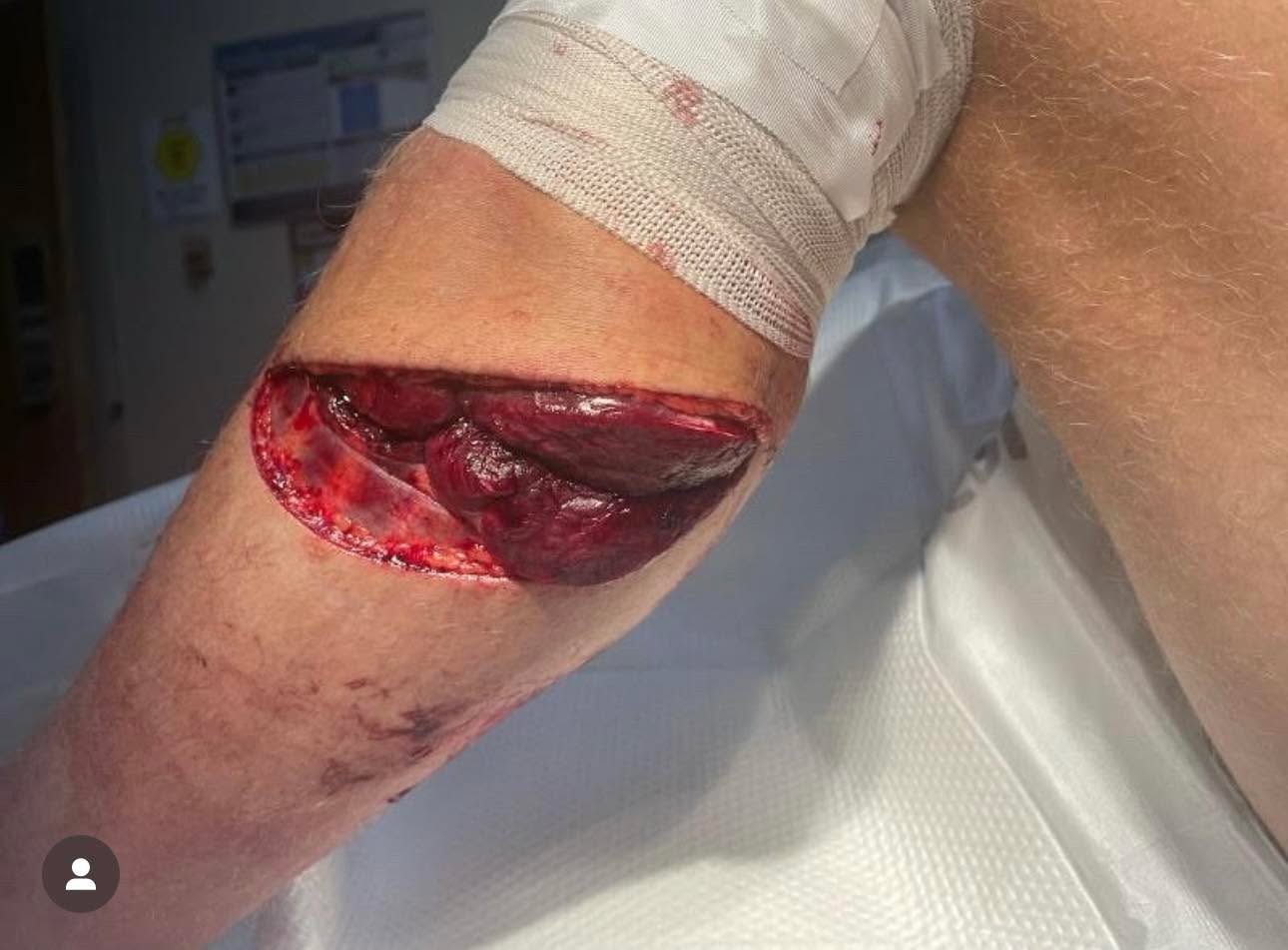 ⚠️ Fire/EMS, how would you take care of? ⚠️
Fell while skiing and in a freak accident got s*ced open by the blade of the ski. Huge venous bleed and you can see muscle protruding post-injury.
Credit: @specialforcesmedics
#tactical #save #human #trauma #training #teaching #learning #community #medical #bethechange #life #vaemstg #emt #firefighter #fire #paramedic #ems #reels #school #education #virginia #group #youtube #knowledge #instagram #trending #facebook