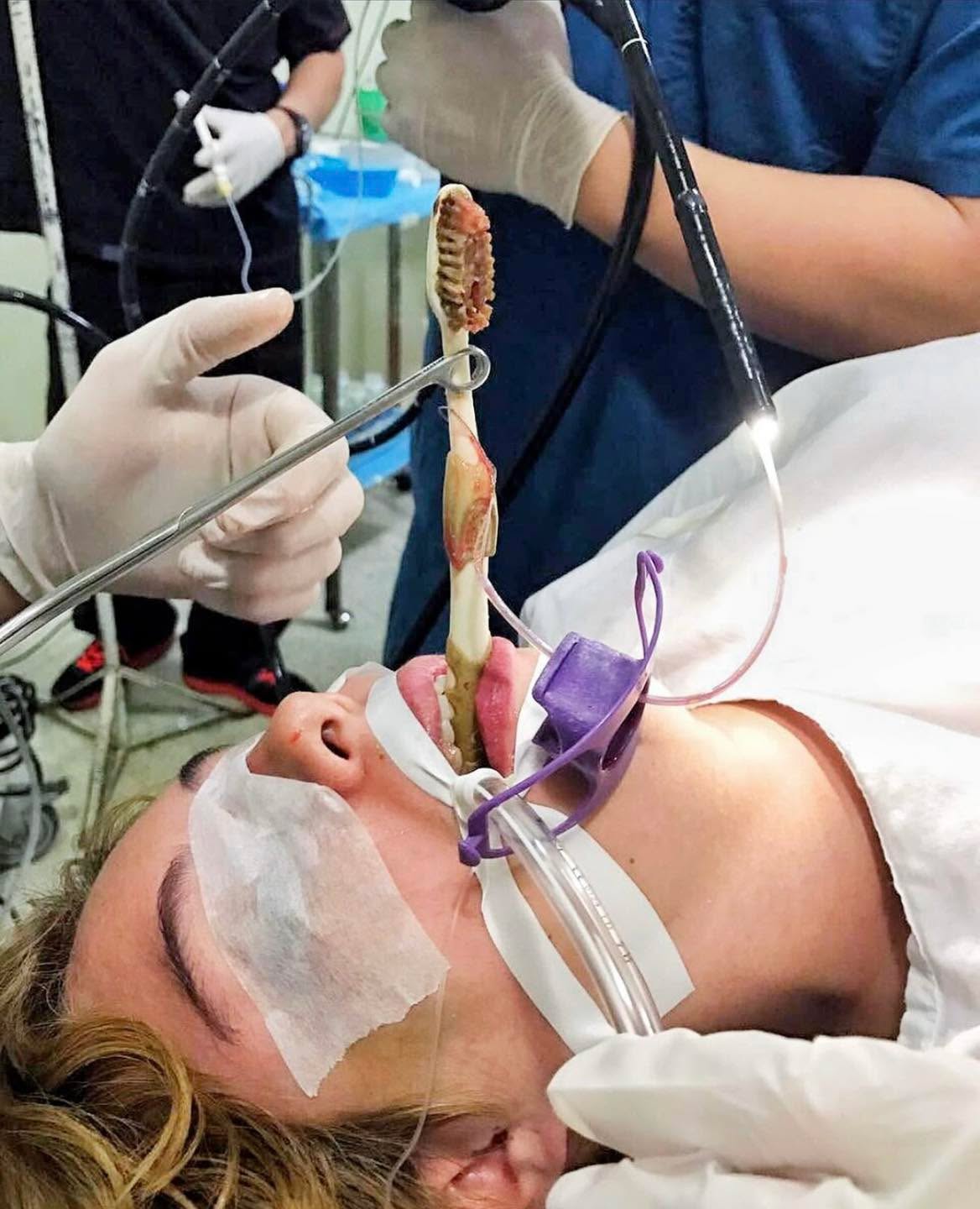 A 26-year-old female presented to the emergency department after accidentally swallowing a toothbrush, which she had inserted into her mouth to induce vomiting. She reports a 6-month history of bulimia nervosa. The toothbrush was successfully retrieved via upper gastrointestinal endoscopy.
Credit: medicaltalks
#tactical #save #human #trauma #training #teaching #learning #community #medical #bethechange #life #vaemstg #emt #firefighter #fire #paramedic #ems #reels #school #education #virginia #group #youtube #knowledge #instagram #trending #facebook