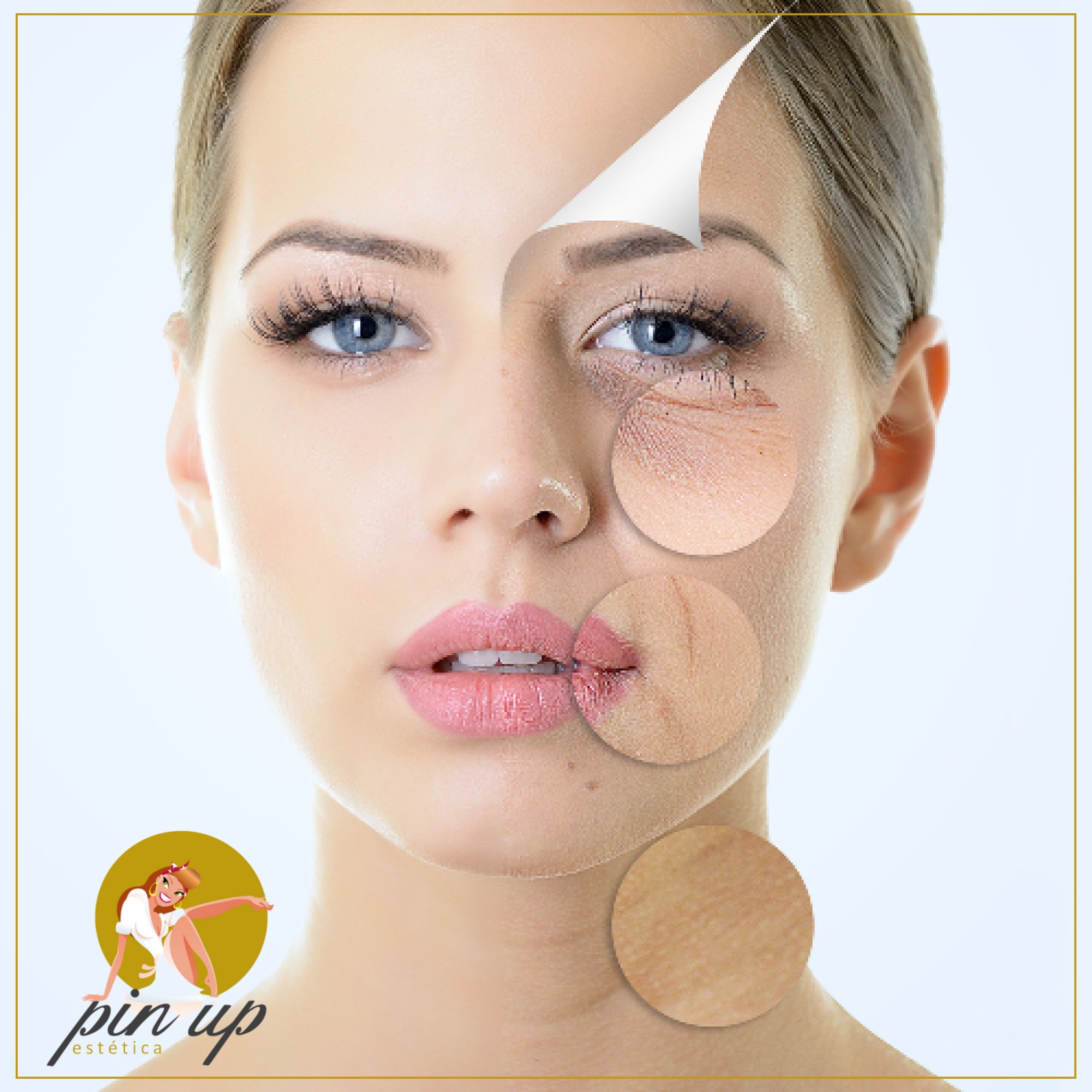 𝙁𝙤𝙩𝙤𝙧𝙚𝙟𝙪𝙫𝙚𝙣𝙚𝙘𝙞𝙢𝙞𝙚𝙣𝙩𝙤 𝙘𝙤𝙣 𝙄𝙋𝙇
El IPL o luz pulsada intensa, es una fuente lumínica de alta intensidad que emite puntos de luz con distinta longitud de onda, permitiendo trabajar al mismo tiempo diferentes aspectos de la piel. Un tratamiento de rejuvenecimiento sumamente efectivo, que consigue una piel luminosa y renovada.
Con el paso del tiempo y la exposición solar continua nuestra piel sufre, y lo demuestra mediante la aparición de manchas, áreas enrojecidas, pequeñas venitas, poros dilatados, arrugas y un engrosamiento de la capa más superficial de la piel que le da un tono más amarillento y apagado, no solo en el rostro sino también en cuello, escote y manos.
Existen tratamientos que pueden tratar de manera independiente cada una de estas lesiones o irregularidades, como los peelings o distintos láseres.
Sin embargo el IPL supone un mayor beneficio frente a estas opciones, y es su versatilidad. En una sola sesión, podemos trabajar al mismo tiempo sobre todas las alteraciones descritas anteriormente, corrigiendo y actuando de manera individualizada en cada una de ellas para conseguir el resultado deseado y mejorar globalmente la textura y calidad de la piel, estimulando además la producción de colágeno.
🥰𝙉𝙤 𝙚𝙨𝙥𝙚𝙧𝙚𝙨 𝙢𝙖́𝙨, 𝙫𝙚𝙣 𝙖 𝙘𝙤𝙣𝙤𝙘𝙚𝙧𝙣𝙤𝙨
📍Avenida Carlos III, 216
04720 · Aguadulce · Almería
📞+950 347 294
💻https://www.pinupestetica.com/
#bellezafacial #estetica #centrodebellezaviolet