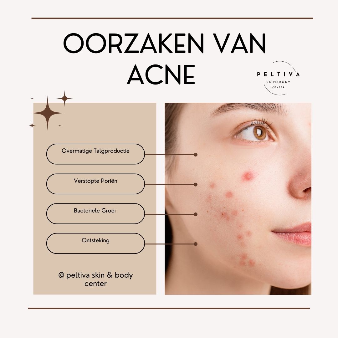 🎯Wetenschappelijke Huidverzorging
Oorzaken en Behandelprincipes van Acne
�
Acne kan worden ingedeeld in drie of vier niveaus op basis van de ernst van de huidletsels. Het begrijpen van de oorzaken en behandelprincipes van acne is essentieel voor een effectieve behandeling.
Heb je last van acne en zoek je een deskundige en effectieve oplossing? Neem contact met ons op voor een gratis consult! Bij Peltiva stellen we een persoonlijk behandelplan voor je samen.
#acnebehandeling #acnebehandelingen