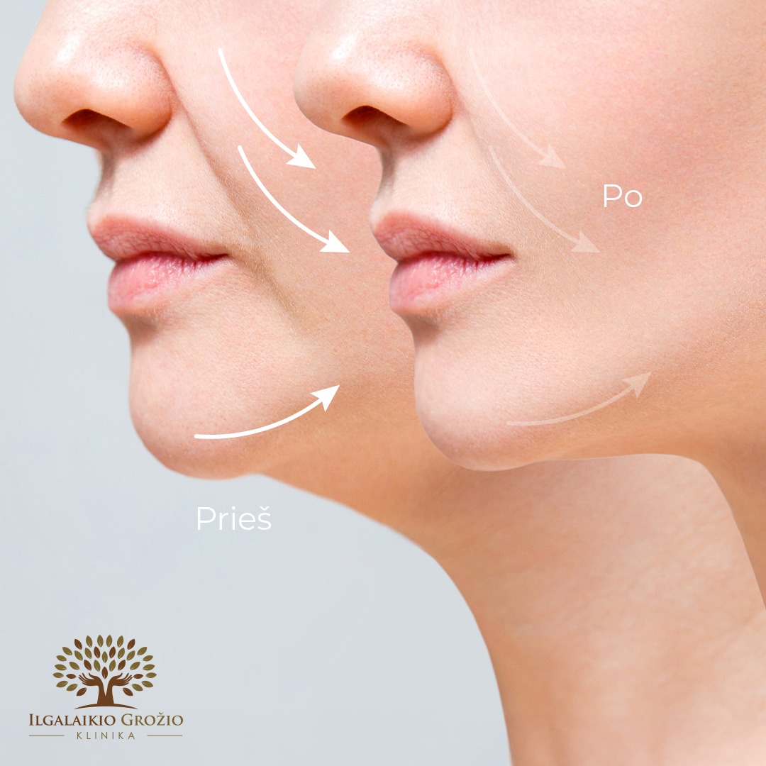 Ryškesni veido kontūrai ir mažiau pastebimi senėjimo požymiai? Išbandykite odos atjauninimo revoliuciją – HIFU ULTRACELL Q+ ✨
Procedūra veikia giliausius odos sluoksnius, skatindama natūralią kolageno gamybą: rezultatai gali būti prilyginami plastinei chirurgijai!
Iki sausio 20 d. žandikaulio linija + pagurklis tik 319€ vietoje 716€. Registruokitės ilgalaikiams pokyčiams:
📞 Telefonu: +370 670 14491
➡ Internetu: @ilgalaikio_grozio_klinika Treatwell programėlėje
💬 Asmenine žinute
🗺 Kaune, Savanorių pr. 139
#Kaunas #groziosalonas #ilgalaikisgrozis #HIFU #odosstangrinimas #veidokonturavimas #pagurkliomazinimas #rezultatai