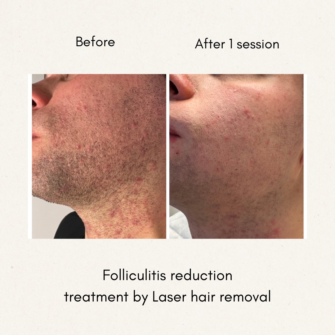 Folliculitis Reduction with Laser Hair Removal
Folliculitis, an inflammation of hair follicles often caused by bacteria, friction, or ingrown hairs, can be effectively reduced with laser hair removal. By targeting and destroying hair follicles at the root, laser treatment minimizes hair growth, reducing the risk of irritation and infection.
This method is particularly beneficial for individuals prone to recurring folliculitis, especially in areas like the beard, bikini line, or underarms. Over multiple sessions, laser hair removal can lead to smoother skin, fewer breakouts, and long-term relief from folliculitis-related discomfort;
do you also suffer from this skin problem? book an appointment with us to discuss about it with our expert!
#laserontharing #schoonheidsspecialiste #schoonheidssalon #overpelt #pelt #lommel #mol #eksel #houthalen