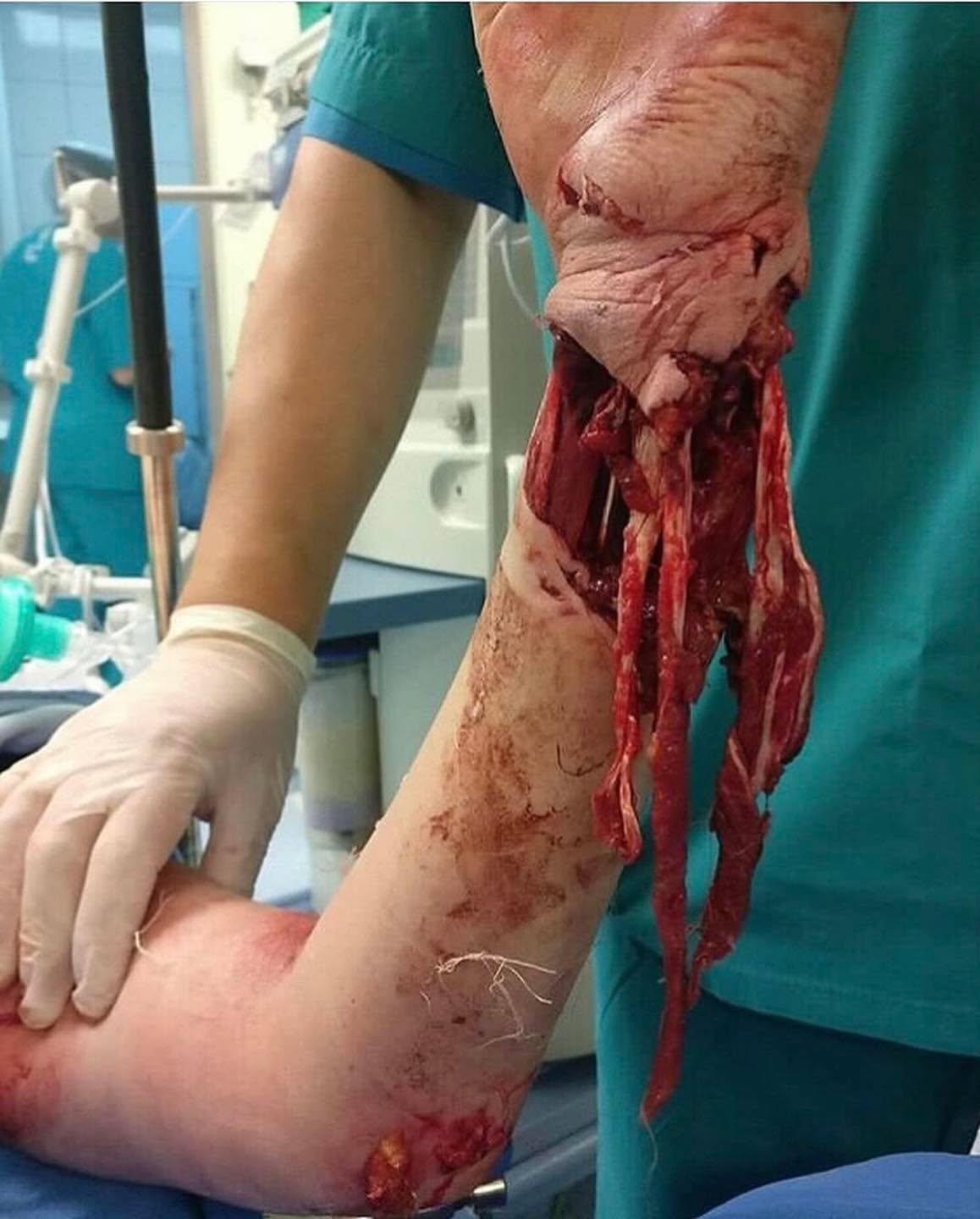 Attention all followers: don't play with bears!
This case illustrates the severe consequences of attempting to engage with a bear in an enclosed environment. The individual entered the bear's cage and attempted to feed the animal by hand, resulting in a violent attack.
The bear inflicted significant trauma to the patient's forearm, including laceration of the tendons and extensive damage to both the flexor and extensor muscle groups. The patient was promptly transported to a medical facility where the forearm was surgically stabilized. Regrettably, the extent of the injuries suggests that the patient may experience a permanent reduction in forearm functionality.
Credit: medicaltalks
#tactical #save #human #trauma #training #teaching #learning #community #medical #bethechange #life #vaemstg #emt #firefighter #fire #paramedic #ems #reels #school #education #virginia #group #youtube #knowledge #instagram #trending #facebook