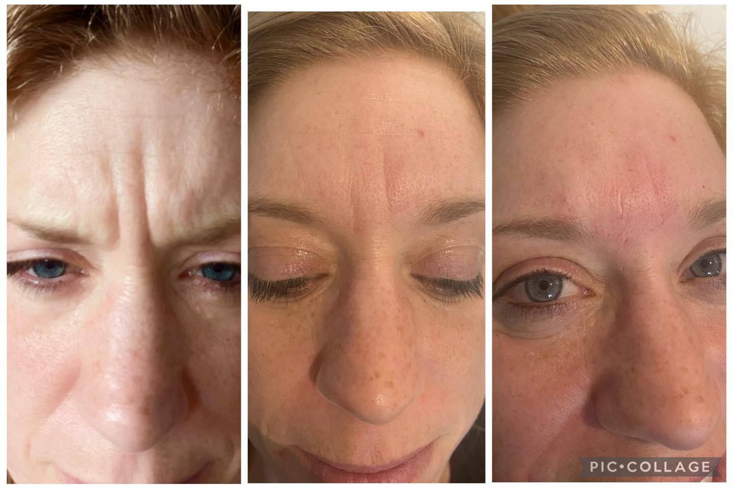 Amazing what a little Botox and filler can do 🥰🥰