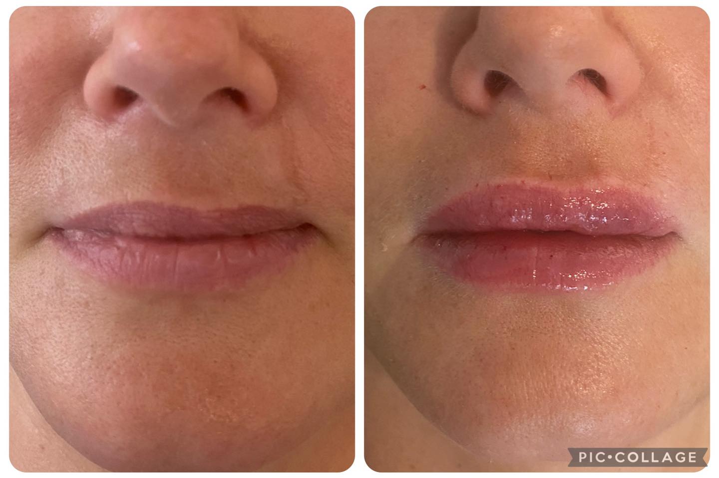 I have been working on my lovely client for a while now.
With a scar which has pulled her natural lip over and caused an uneveness, we have been working on filling and bringing back a level of symmetry to the lips.
No needle lip filler method used. This is a lot safer. Minimal bruising. Swelling and pain.
Pop in and see me and add a little plumpness back to your lips for £159.
I am the queen of natural so whether you are just wanting a little filling that has been lost with age. Or whether you want a lift to your upper lip. Or symmetry between top and bottom. I can help.