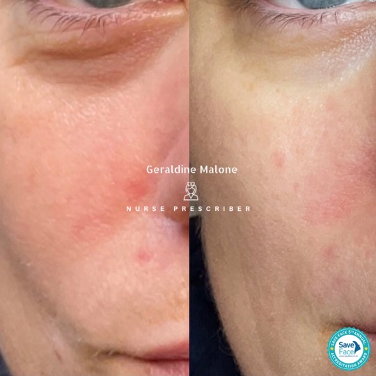 Results from 2 Sessions of Polynucleotide Treatment (skin booster)
The polynucleotides are of natural origin and derived from European freshwater fish intended for human consumption.
Benefits:
- Reduction of fine lines & wrinkles
- Improved skin tone quality
- Improvement of skin structure and elasticity,
- Boosts collagen levels,
- Improve the outcomes of other skin rejuvenation
Treatment Price: £180 Per Session
A course of 3 treatments is recommended
Book in now via our website at :
https://geraldinemalone.co.uk/#book
📍Clinic Based in CV6 1EB
☎️ 024 7792 1812