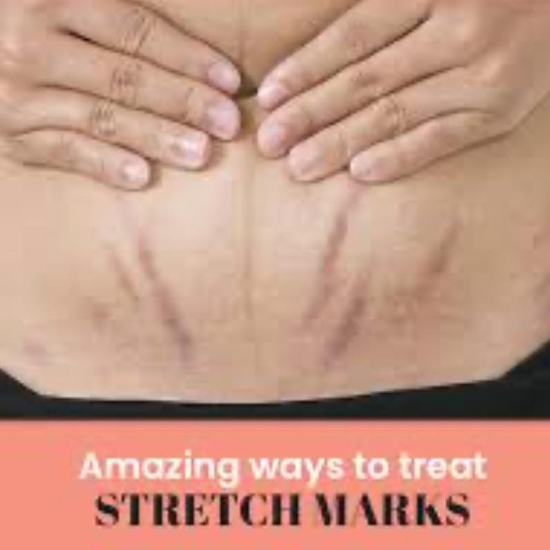 Ask me how I can help your stretch marks.
With Polynucleotides which help the cells within the skin to regenerate and a specific repair mesotherapy cocktail to help reduce the redness and help minimise them, I have everything I need to help you with these.
#stretchmark #stretchmarkremovalcream #mesotherapy #polynucleotides #crickhowell