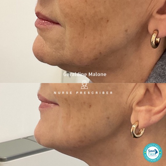 Improvement in Skin Integrity Achieved with 2 sessions of PROFHILO STRUCTURA @ha_dermauk
This treatment is tailored to each patient's unique needs and focuses on restoring the loss of fat pad compartments caused by aging.
For optimal results, 2 treatments are recommended 4 weeks apart, followed by maintenance treatment after 6 months with just one treatment only.
In line with IBSA Derma's changes in September
2023 across the UK and Ireland, all Profhilo products are labeled with a hologram to help give patients the peace of mind that they are authentic.
Are you a sinker or a sagger? Book Now via the link below to see how PROFHILO STRUCTURA can work for you.
🔗 https://www.geraldinemalone.co.uk/book-appointment
📍 Save Face Registered Clinic in CV6 1EB
📞 24 7792 1812
📧 geraldinemaloneaesthetics@outlook.com