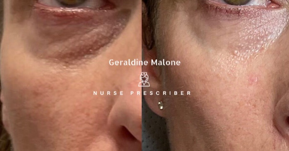 Polynucleotide Treatment Results (skin booster)- in just 3 sessions.
The polynucleotides are of natural origin and derived from European freshwater fish intended for human consumption.
Benefits:
• Reduction of fine lines & wrinkles
• Improved skin tone quality
• Improvement of skin structure and elasticity,
• Boosts collagen levels,
• Improve the outcomes of other skin rejuvenation treatments
• Treatment Price: £180 Per Session
• A course of 3 treatments is recommended
Book in now via our website at :
https://geraldinemalone.co.uk/#book
📍Clinic Based in CV6 1EB
☎️024 7792 1812