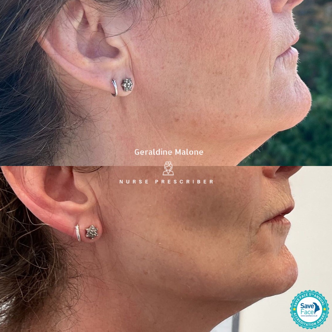 Improvement in Skin Integrity Achieved with 2 sessions of PROFHILO STRUCTURA @ha_dermauk
This treatment is tailored to each patient's unique needs and focuses on restoring the loss of fat pad compartments caused by ageing.
For optimal results, 2 treatments are recommended 4 weeks apart, followed by maintenance treatment after 6 months with just one treatment only.
In line with IBSA Derma's changes in September
2023 across the UK and Ireland, all Profhilo products are labeled with a hologram to help give patients the peace of mind that they are authentic.
Are you a sinker or a sagger? Book Now via the link below to see how PROFHILO STRUCTURA can work for you.
🔗 https://www.geraldinemalone.co.uk/book-appointment
📍 Save Face Registered Clinic in CV6 1EB
📞 024 7792 1812
📧 geraldinemaloneaesthetics@outlook.com