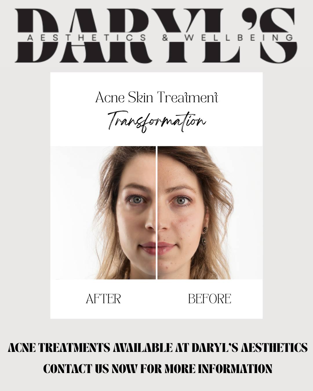 🌟 Clearer Skin Starts Here at Daryl's Aesthetics 🌟
Struggling with acne or post-acne scarring? You're not alone—and you're not out of options. At Daryl's Aesthetics, we take a personalised approach to treating acne at every stage, combining medical-grade skincare, advanced microneedling, targeted chemical peels, and carefully selected cosmetic injectables to restore your skin’s clarity and confidence.
✨ Whether you're battling active breakouts or lingering scars, our expert team creates a tailored plan just for you.
Book now for your free skincare consultation!
#DarylsAesthetics #AcneSolutions #Microneedling #ChemicalPeels #ClearSkinJourney #CosmeticInjectables #PersonalisedSkincare #SkinConfidence
