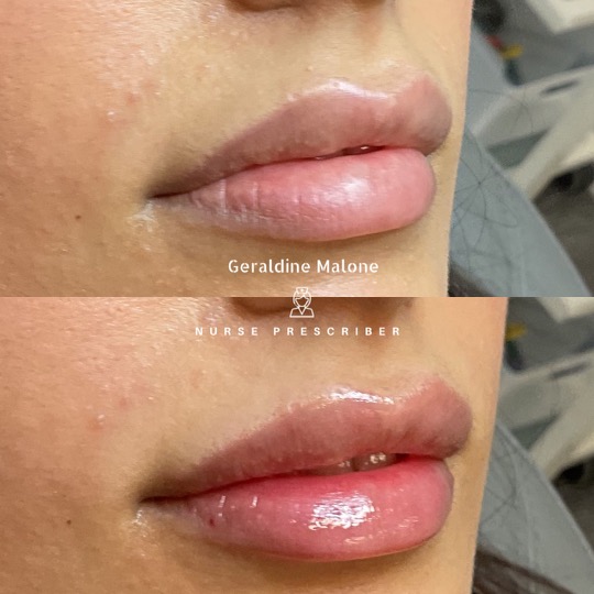 Lips Enhanced with 0.5ml Top Quality Dermal Filler
- Hydration and subtle volume, whilst maintaining natural shape and proportion
- NO edited images
- Treatment price: 0.5ml/£145, 1ml/£225
- Recovery time: 24/48hrs
- Results lasting 6-12 months
- All treatments carried out by Nurse Prescriber Geraldine Malone in a Save Face Registered Clinic
Book Now via the link below:
https://www.geraldinemalone.co.uk/book-appointment
Contact Us:
📞 024 7792 1812
📧 geraldinemaloneaesthetics@outlook.com