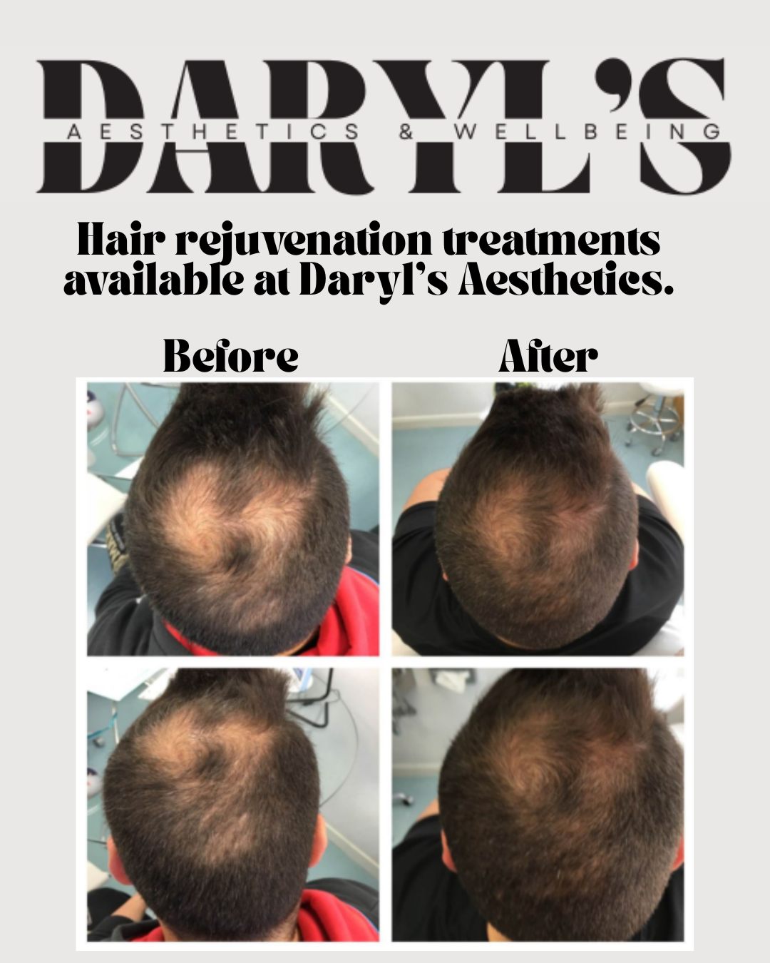 ✨ Thicker, healthier hair starts at the scalp — and at Daryl's Aesthetics ✨
We’re proud to offer Plinest Hair, an advanced injectable treatment using polynucleotides to rejuvenate the scalp, boost circulation, and naturally stimulate hair growth.
Whether you're noticing early signs of thinning or just want to revitalise your hair, Plinest Hair is a clinically backed, non-surgical solution trusted by both men and women.
💆♀️ Results? Stronger roots, improved density, and restored confidence.
📍 Available now at Daryl's Aesthetics
📩 Contact us to book your consultation or find out more!
#DarylsAesthetics #PlinestHair #HairRestoration #ScalpHealth #Polynucleotides #HairCareClinic #HealthyHairJourney #HairRejuvenation #HairLossSolution #ThickerHair #HairConfidence #NonSurgicalHairTreatment #AestheticClinic #HairTransformation