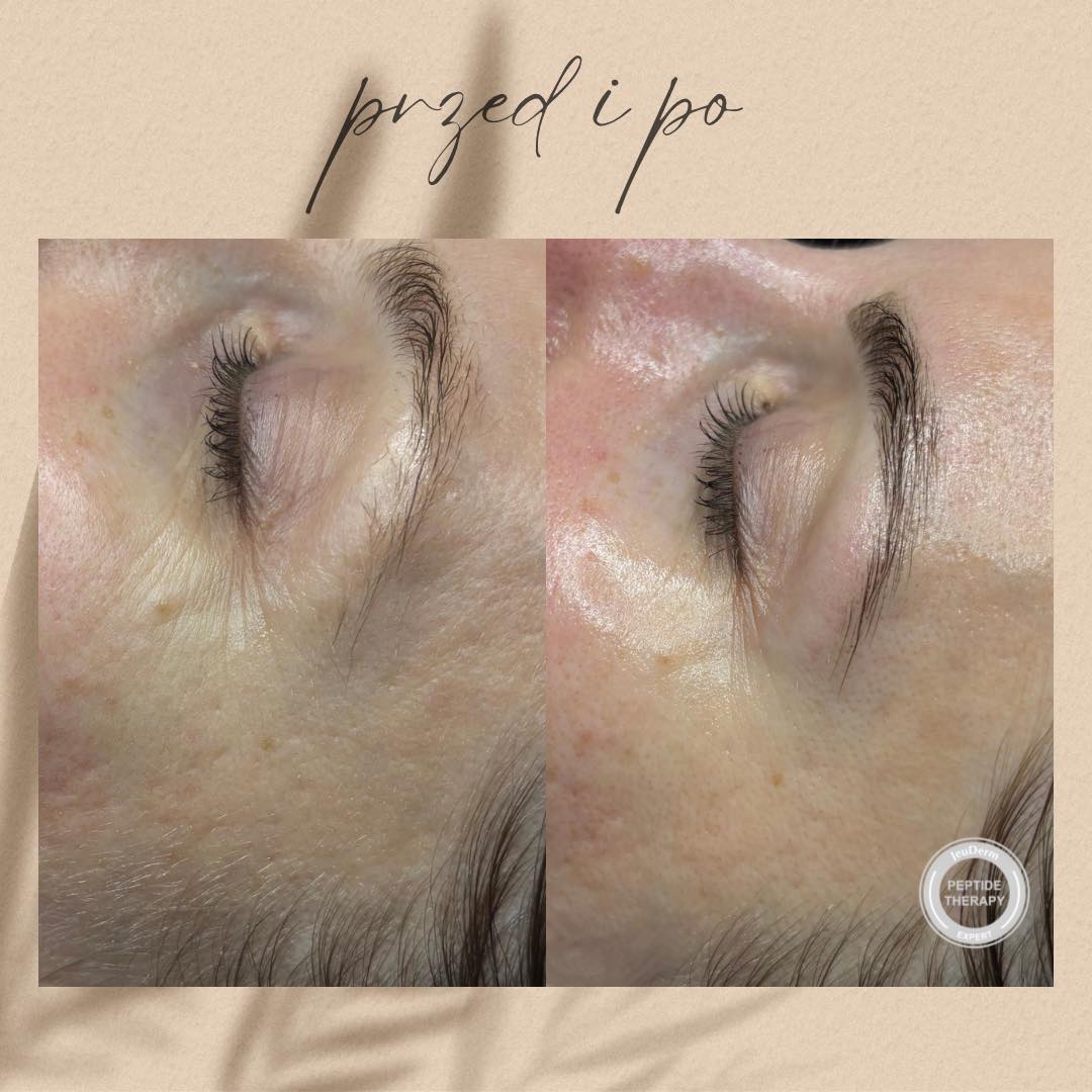 Dzień dobry 😍 takie efekty bezpośrednio po zabiegu z egzosomami 💕 zobaczcie tylko jak zmieniła się skóra 🙌
Coś więcej o zabiegu:
Zabieg gwarantuje uzyskanie promiennej skóry, a wysokie stężenie egzosomów w połączeniu z peptydami, probiotykami, ekstraktami roślinnymi , kwasem hialuronowym i betainą, ma za zadanie zwalczać kluczowe oznaki starzenia: zmarszczki, przebarwienia, zwiotczenie i matowość. ❤️🔥
Zabieg sprzyja aktywnej regeneracji , zapewnia ekspresowe nawilżenie i daje efekt liftingu. 😍Wyrównuje koloryt i teksturę skóry, zapewnia ochronę antyoksydacyjną i zmniejsza działanie zewnętrznych czynników drażniących.💕💕💕
Zabieg poprawia mikrokrążenie , uelastycznia i odświeża skórę , jednocześnie działając kojąco i redukując obrzęki ❤️
Ten i inne zabiegi na twarz polecają się na prezent świąteczny 🎄 napisz do nas by dowiedzieć się więcej o voucherach ➡️ możemy wysłać Wam voucher elektroniczny lub możemy umówić się na odbiór voucherów papierowych 🎁🎁🎁
Podaruj najbliższym relaks i piękne efekty w nurcie holistycznej kosmetologii i pielęgnacji 🎄