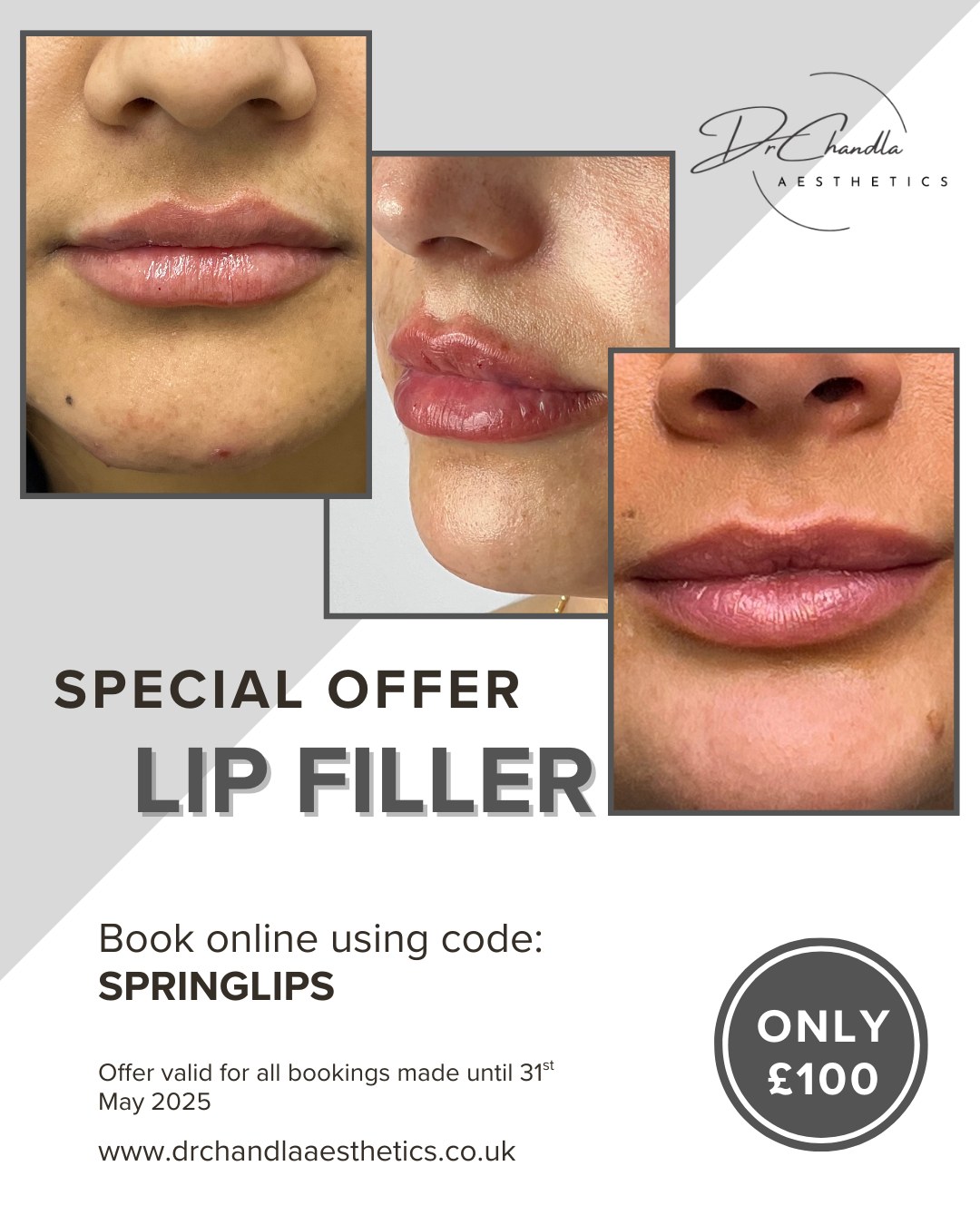 Ready for Perfect Lips this Spring? 💋
Let your confidence bloom this season with our exclusive Spring Lip Filler Offer!
Enhance your natural lip shape, restore volume, and perfect your pout with expertly administered and tailored treatments.
Achieve subtle, sophisticated results that boost your confidence and complement your spring style.
✨ Limited Time Spring Offer ✨: Treatment only £100 when booked online using the code SPRINGLIPS, valid on all bookings made until 31st May 2025.
Don't wait – let your smile blossom!
Dr Chandla Aesthetics is a Doctor Led Medical Aesthetics Clinic.
📞 07930674092
🌐 www.drchandlaaesthetics.co.uk
#drchandlaaesthetics #aestheticsdoctorsolihull #aestheticsdoctorwestbrom #aestheticsdoctorbirmingham #LipFiller #SpringSpecial #LipEnhancement #Aesthetics #SolihullBeauty #BirminghamBeauty #FillerOffer #SpringGlowUp #PoutPerfection #NaturalLips