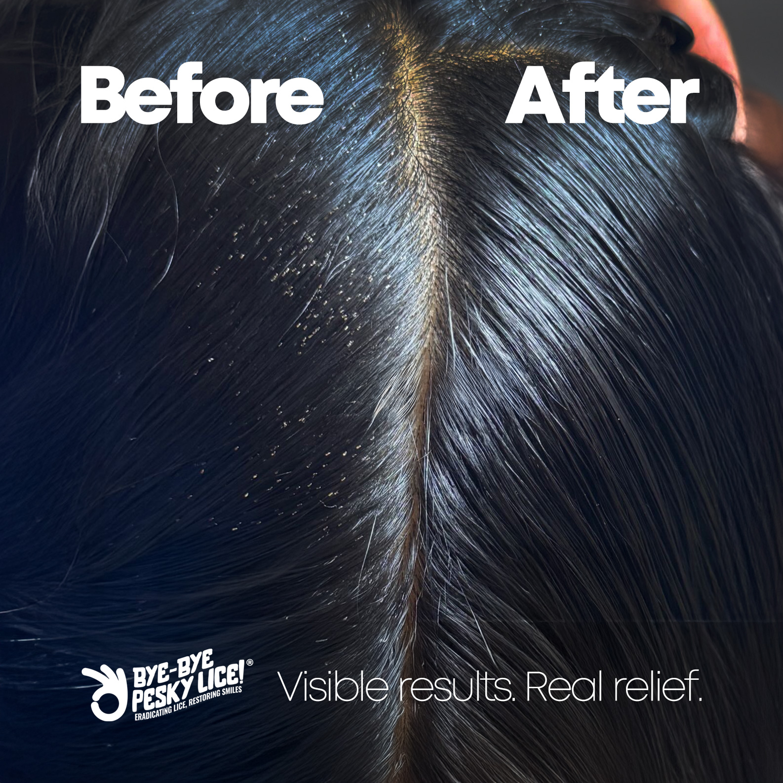 Seeing is believing.
On the Left: hair with visible nits before treatment.
On the right: clean, healthy hair after just one professional session.
This transformation is possible thanks to our thorough process and the continued use of our natural shampoo and conditioner, designed to break the lice cycle and protect after treatment.
💧 Safe for kids
🌿 Non-toxic ingredients
🛡️ Supports our 30-day guarantee
#ByeByePeskyLice #LiceRemoval #BeforeAndAfter #LiceTreatment #NaturalHairCare #LiceFree #ParentSupport #LicePrevention #HeadLiceHelp