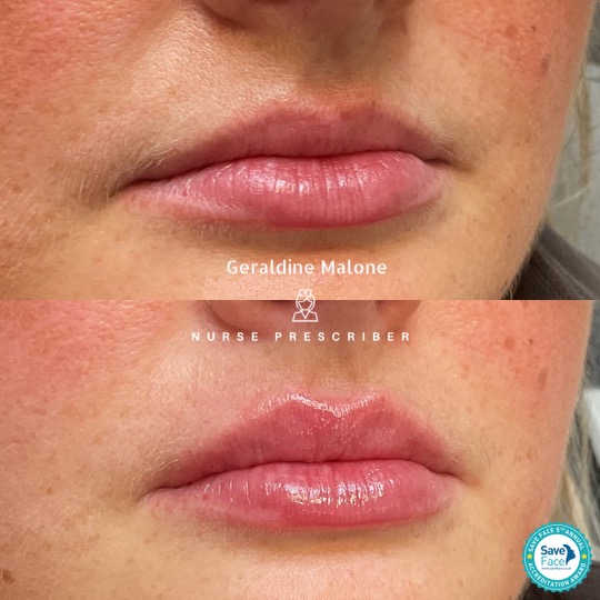 0.5ml Top quality dermal filler used to treat the lips.
- Hydration and subtle volume, definition in the cupids bow all whilst maintaining natural shape and proportion
- NO edited images
- Treatment price: 0.5ml/£145, 1ml/£225
- Recovery time: 24/48hrs
- Results lasting 6-12 months
- All treatments carried out by Nurse Prescriber Geraldine Malone in a Save Face Registered Clinic
Book Now via the link below:
https://www.geraldinemalone.co.uk/book-appointment
Contact Us:
☎️ 024 7792 1812
📧 geraldinemaloneaesthetics@outlook.com