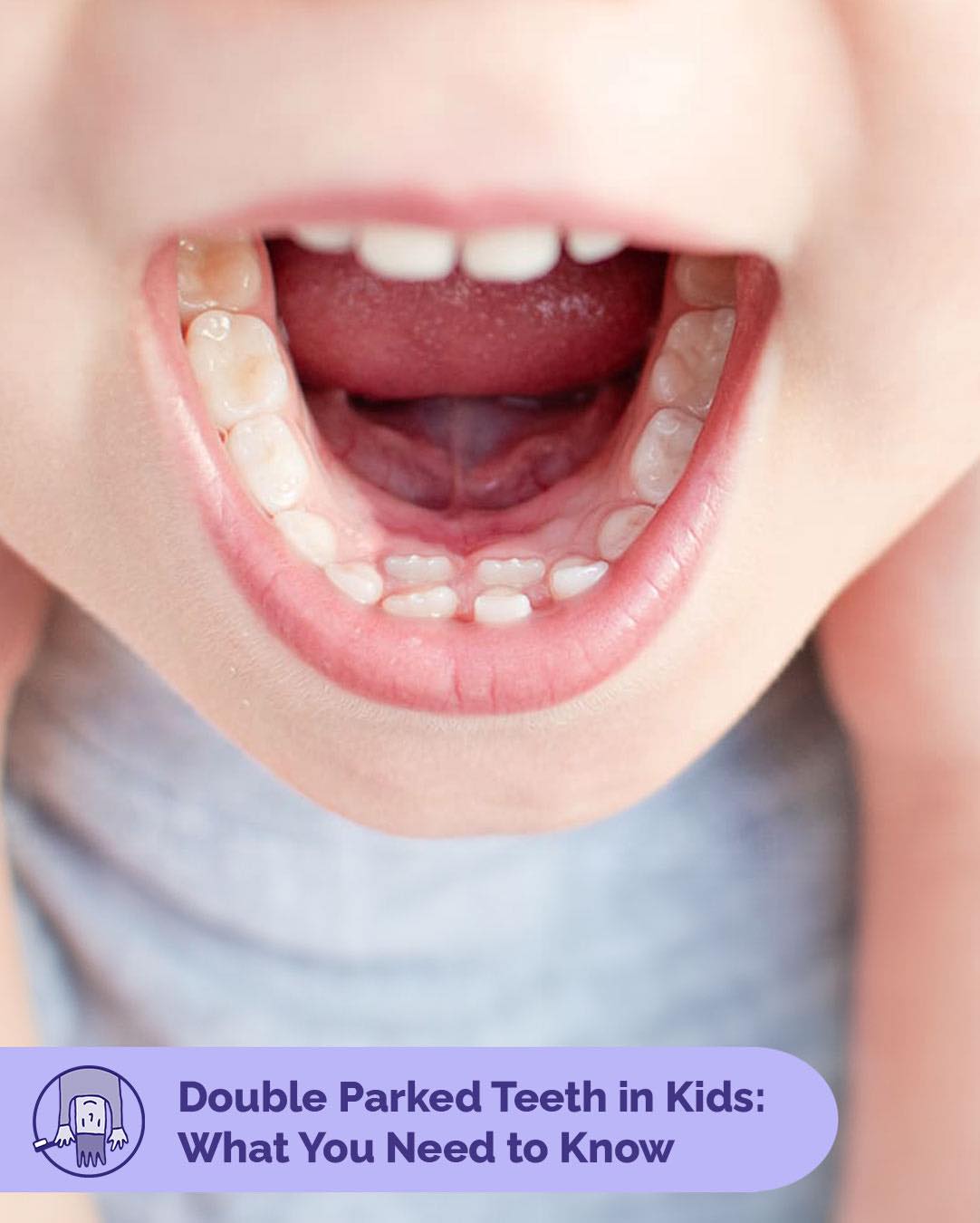 Shark Teeth Alert! Have you noticed a new tooth is growing in behind a baby tooth? Don't worry, this is a common phenomenon! Swipe to learn more.
If you have concerns or questions, feel free to call us or send a picture. We're here to help and we have a helpful handout on double-parked teeth that we can share with you.
#Sharkteeth #PediatricDentist #HealthySmiles #DrGilaDDS #Dentist #Childrensdentist #marindentisty