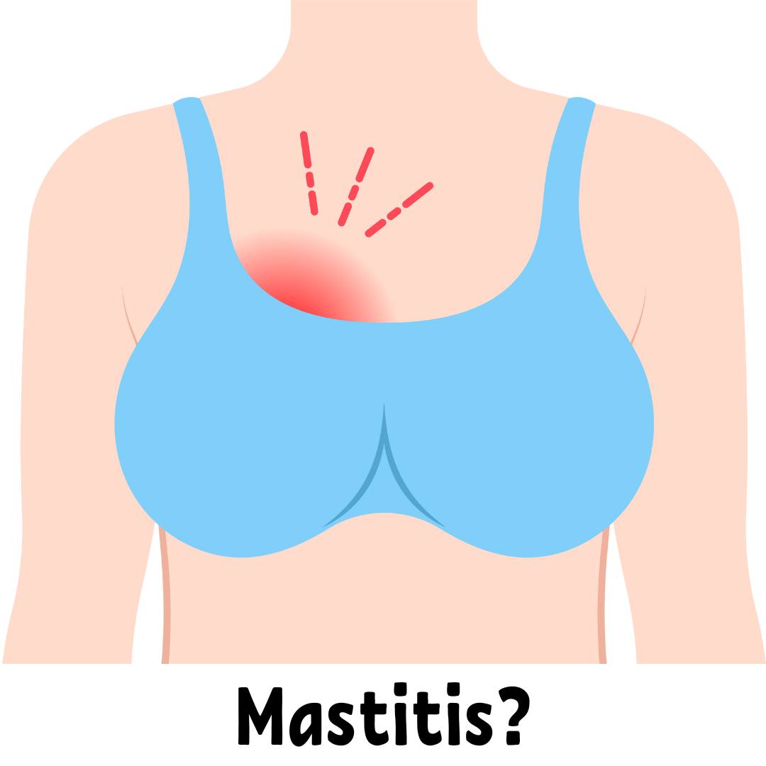 Mastitis? Ouch! Mastitis is an inflammation of the breast that can be caused by obstruction, infection and/or allergy. Mastitis is most common in the first 2-3 weeks, but can occur at any stage of lactation. Mastitis may come on abruptly, and usually affects only one breast. It may be due to:
-Engorgement or inadequate milk removal
-Infrequent/skipped feedings
-Pressure on the duct
-Blocked duct
-Inflammation
-Infection
-Stress, fatigue, anemia, weakened immunity
Mama, be sure you are resting (bed rest, preferably with baby)
Increase your fluids and get adequate nutrition
Get help around the house.
(Maureen Minchin (Breastfeeding Matters, Chapter 6))
Let's talk more at support group Wednesday morning!
#mastitis #normalizebreastfeeding #breastfeedingsupportgroup