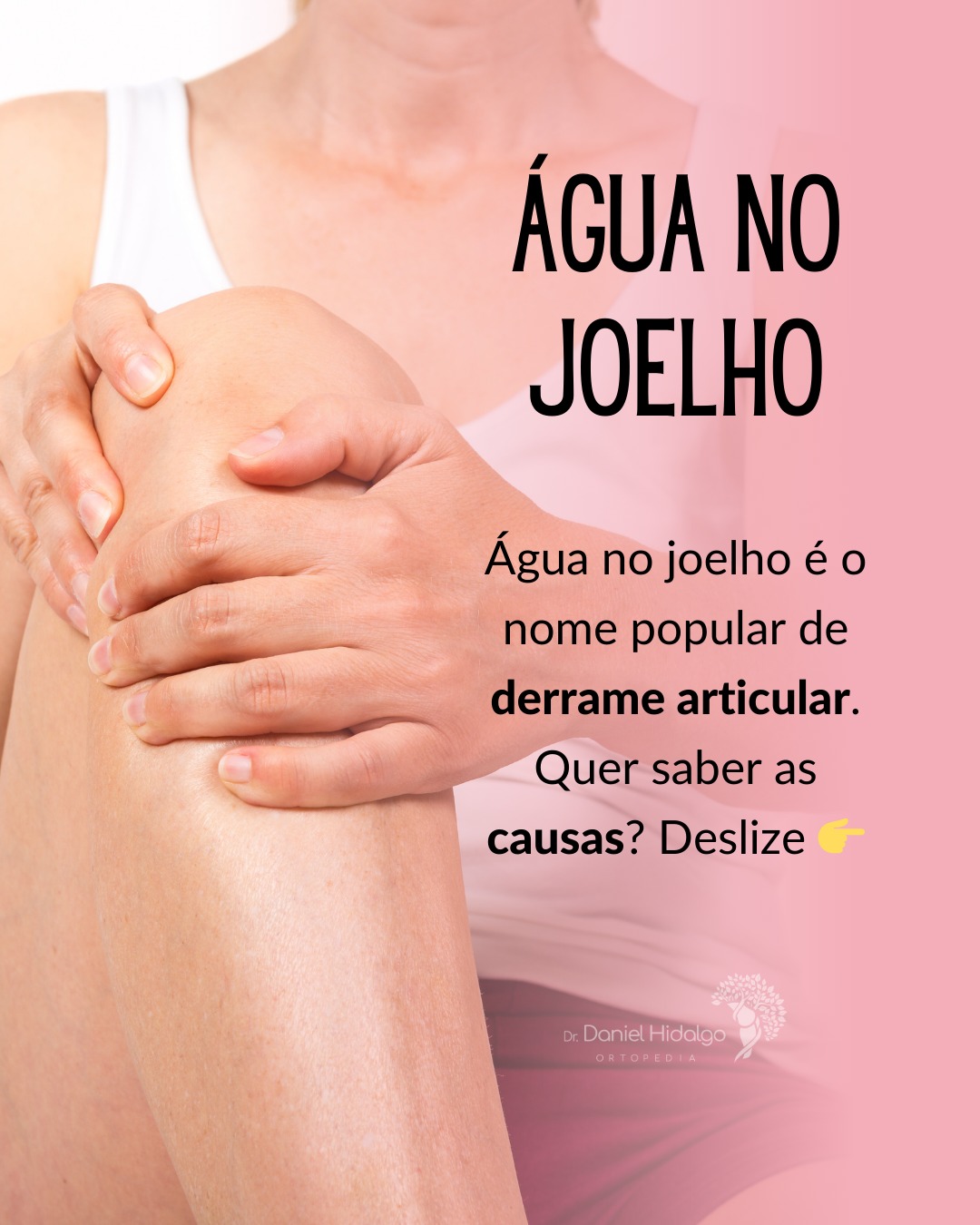 🦵💧 O derrame articular do joelho, popularmente conhecido como "água no joelho", é o acúmulo anormal de líquido dentro da articulação. Pode ser causado por lesões, artrose ou sobrecarga. Os principais sintomas incluem inchaço, dor e dificuldade de movimentação. Se o seu joelho está inchado sem motivo aparente, é hora de investigar!
🔍 Comente aqui suas dúvidas! ⬇️
Dr. Daniel Hidalgo - Médico Ortopedista
CRM-SP 137.057 | RQE 41.112
Membro da Sociedade Brasileira de Ortopedia e Traumatologia (SBOT)
Membro da Sociedade Brasileira de Cirurgia do Joelho (SBCJ)
#Ortopedia #Joelho #DerrameArticular #SaúdeArticular #Prevenção