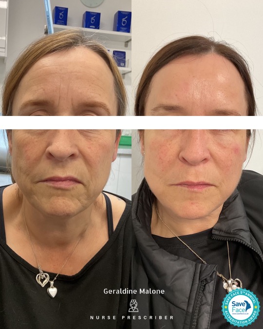 A combination of skin boosters, dermal filler and muscle relaxing treatments for a full face rejuvenation.
Personalised treatment plans are based on an individuals unique skin type, age, concerns and goals.
A gradual approach to face rejuvenation is gentler, lets you track progress and gives a more natural result.
Time and patience is key 🌟
Book your consultation:
https://bookings.gettimely.com/gmaesthetics/book
Contact Us:
📞 024 7792 1812
📧 geraldinemaloneaesthetics@outlook.com
📍CV6 1EB