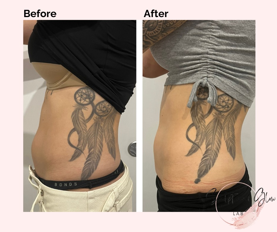 ✨Client Journey✨
Sometimes, it's the subtle changes that can really boost someones confidence!
This gorgeous gal is off on her euro summer trip! We crammed in 5x sessions of SculptX+ to the abdomen & 5x treatments of RF Skin Tightening to the abdomen! Not only have we flattened out the abdomen, the loose skin on the belly button has reduced!
I LOVE what I do! 🫶
1x 30 minute session of SculptX+ ONLY $69!*
1x treatment of RF Skin Tightening to the abdomen ONLY $69!*
This ALSO includes a COMPLIMENTARY application of @skingenau #Slimminggel 👏
Curious about what treatments we offer? Contact @sculptandglowlab NOW to book a FREE consultation!
.
.
*Treatment isn't for everybody. Contact @sculptandglowlab for further information. Individual results may vary.
#clientjourney #ConfidenceBoost #bodysculptingspecialist #fatcavitationperth #rfskintighteningperth #sculptxperth #emsculptperth #musclebuilding #bodybuilding #nurseledlinic #sculptandglowlab